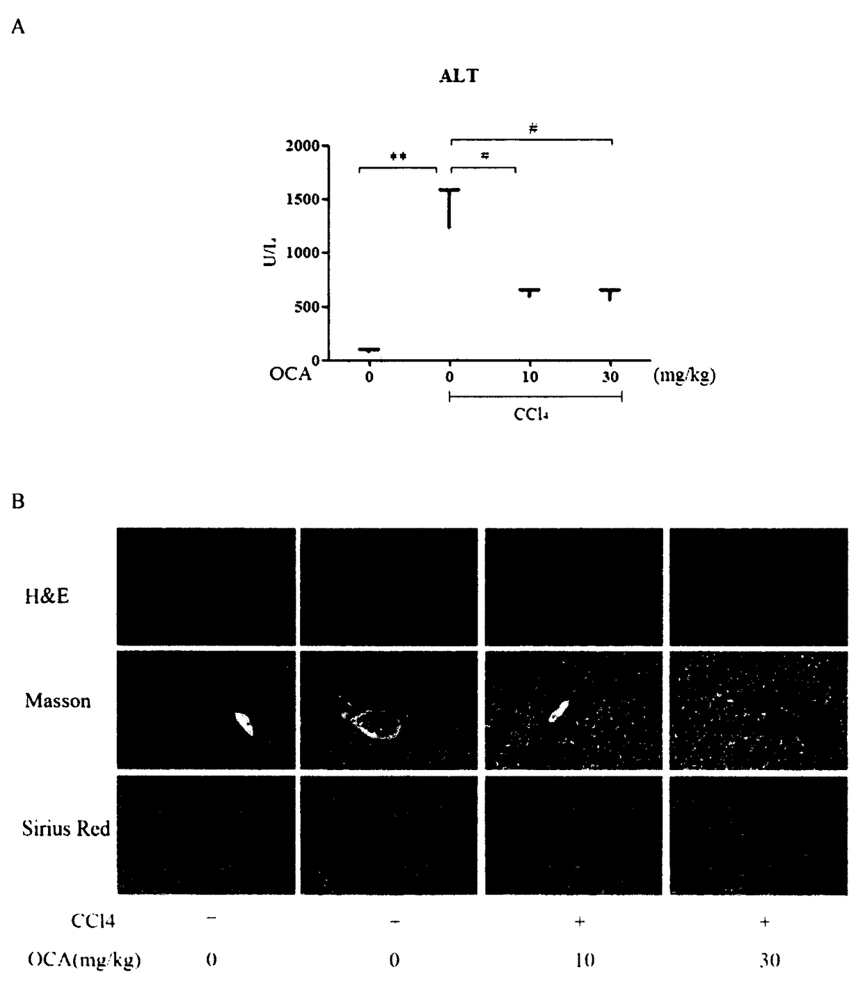 Application of combination of Farnesoid XReceptor (FXR) agonist and apoptotic inhibitor in preparation of superior anti-hepatic fibrosis drugs