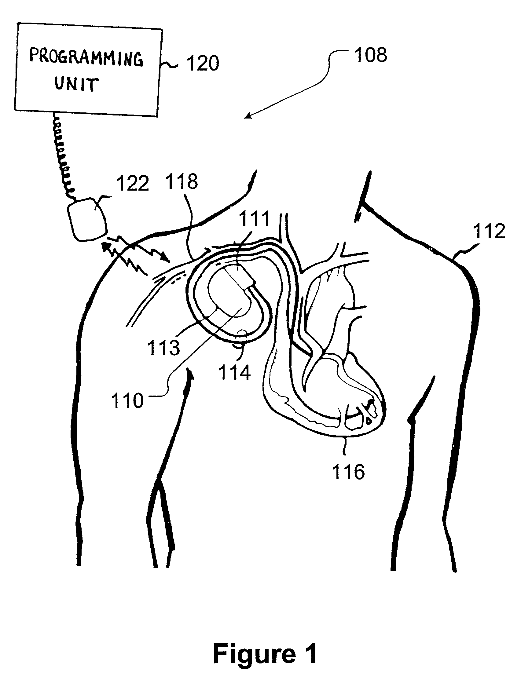Device for sensing cardiac activity in an implantable medical device in the presence of magnetic resonance imaging interference