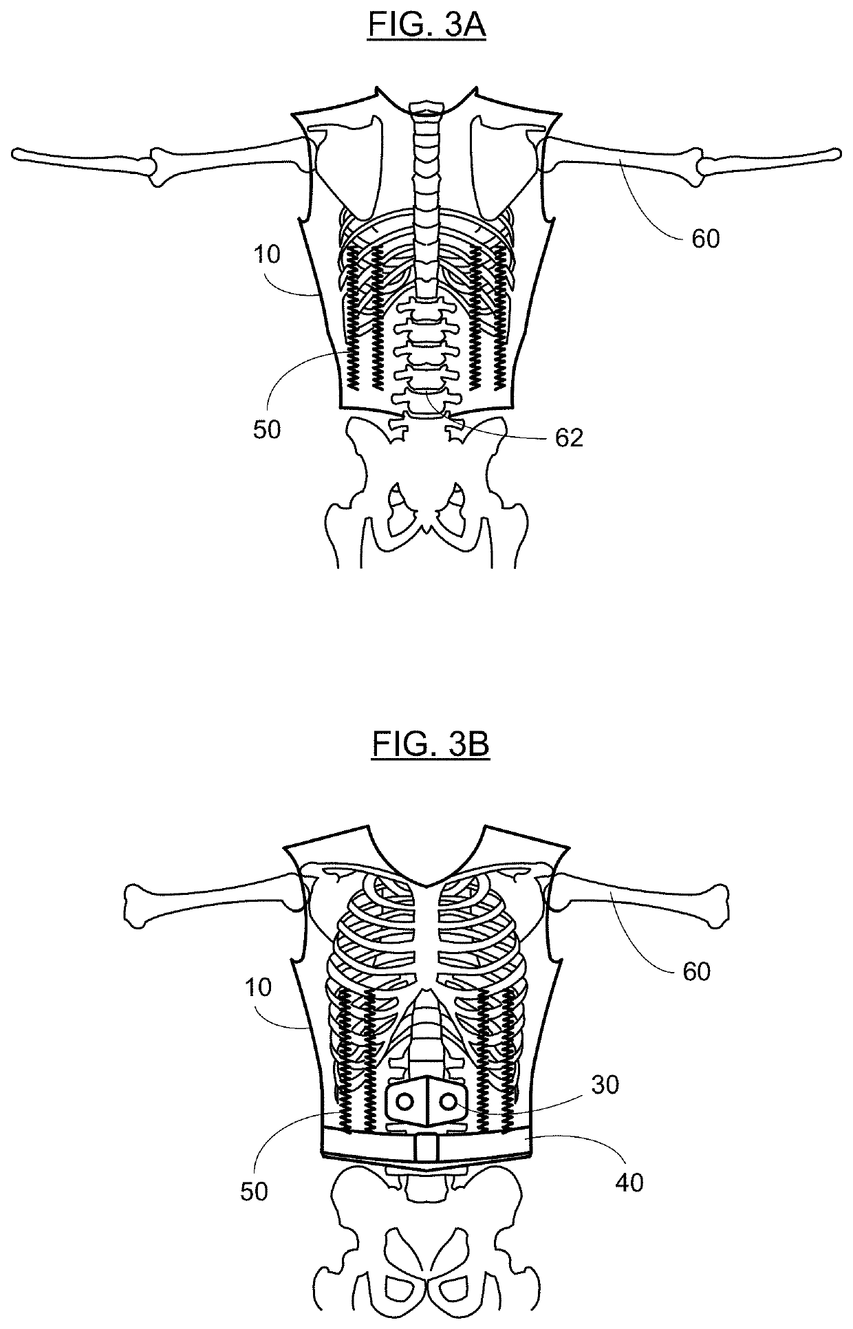 Braces for alleviating compression and methods of making and using the same
