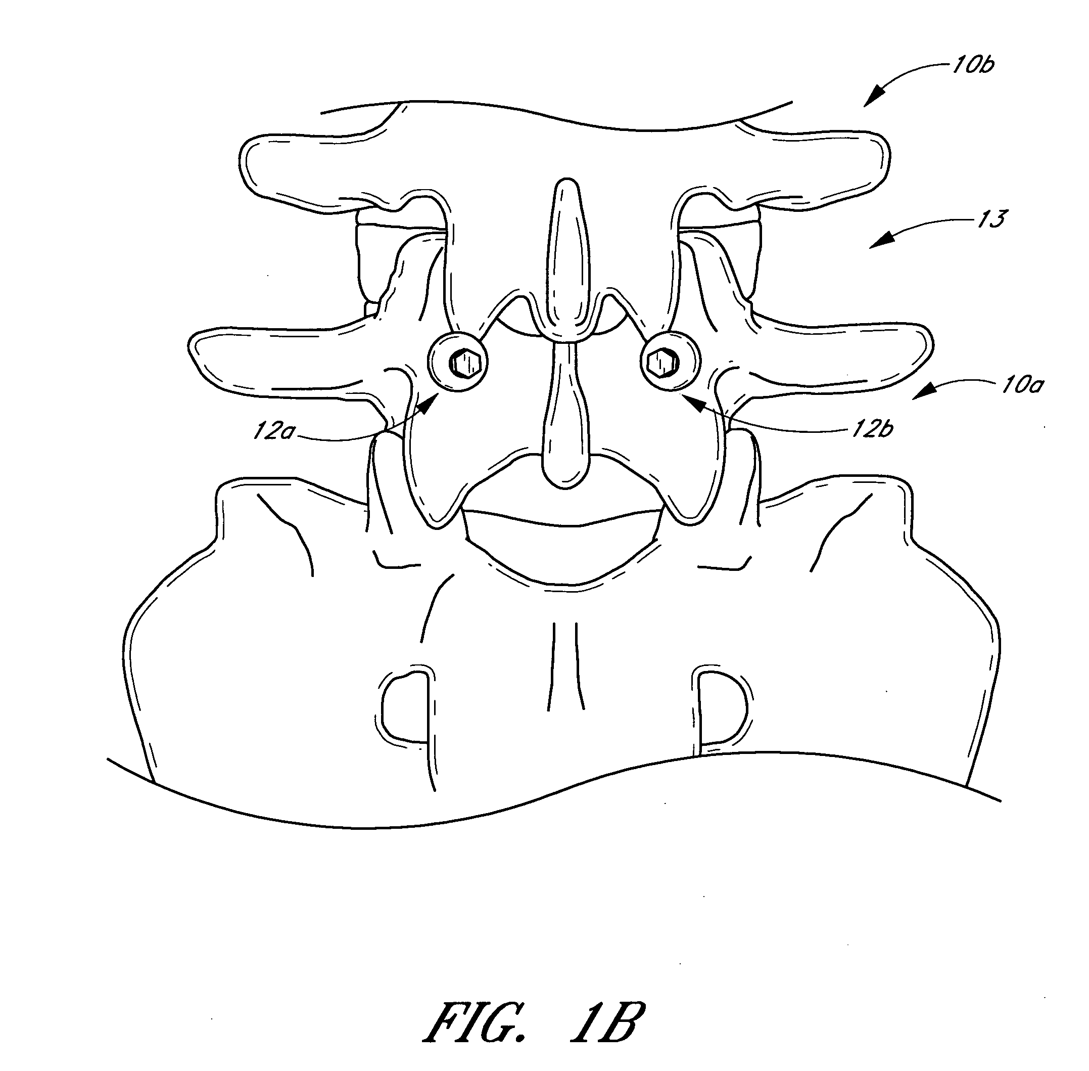 Method and apparatus for spinal stabilization