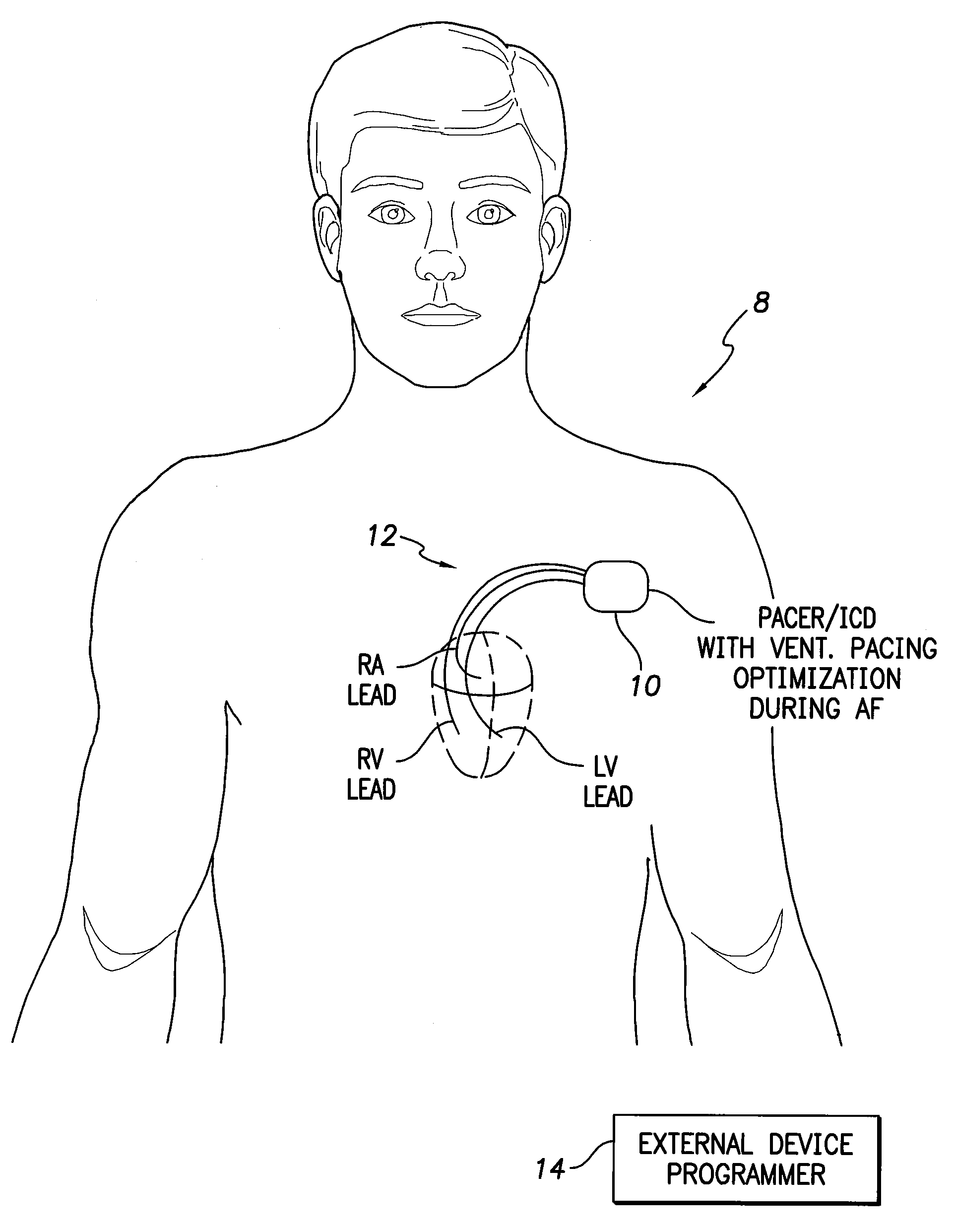 Systems and methods for optimizing ventricular pacing delays during atrial fibrillation