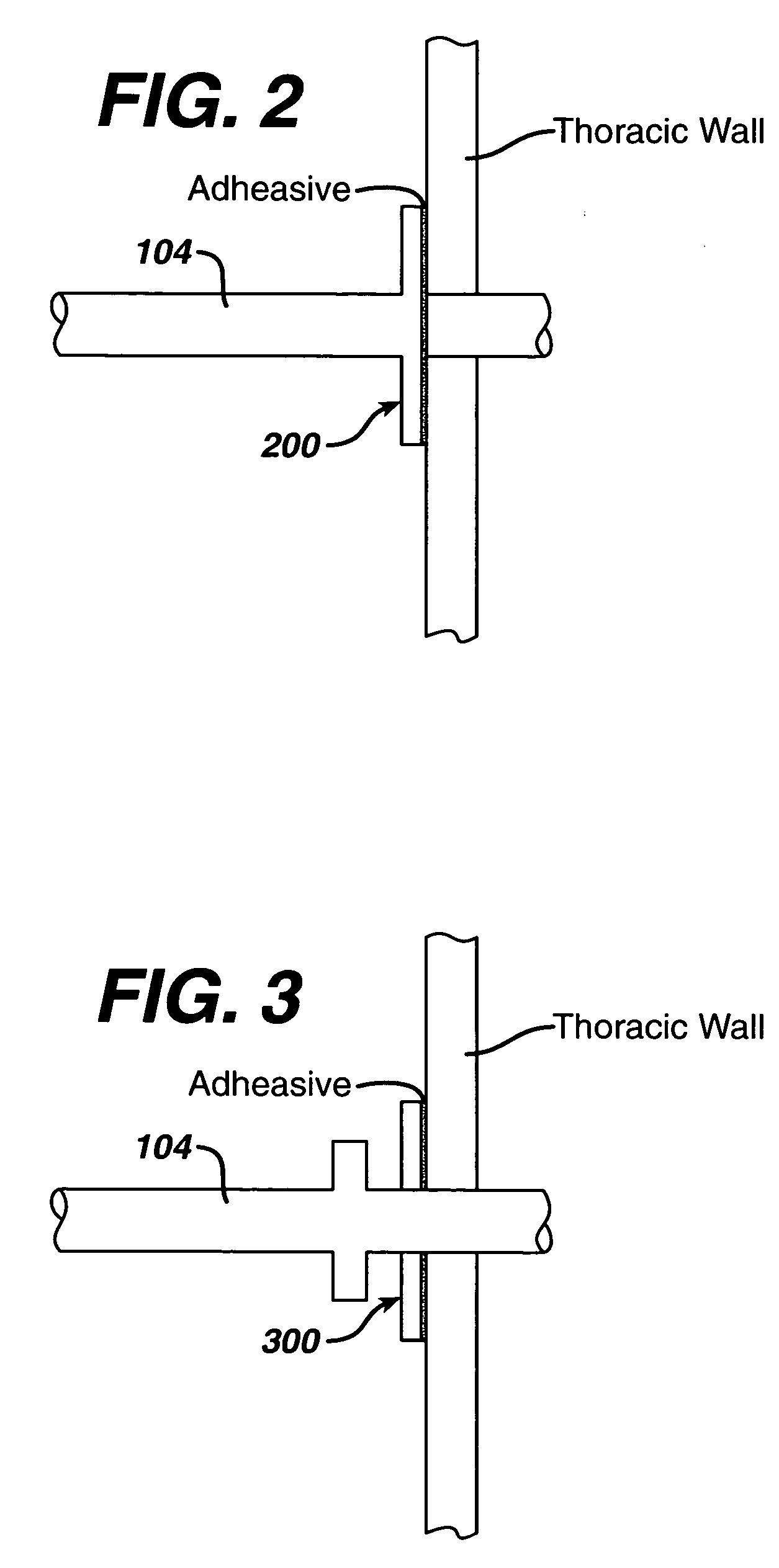 Localized pleurodesis evacuation device