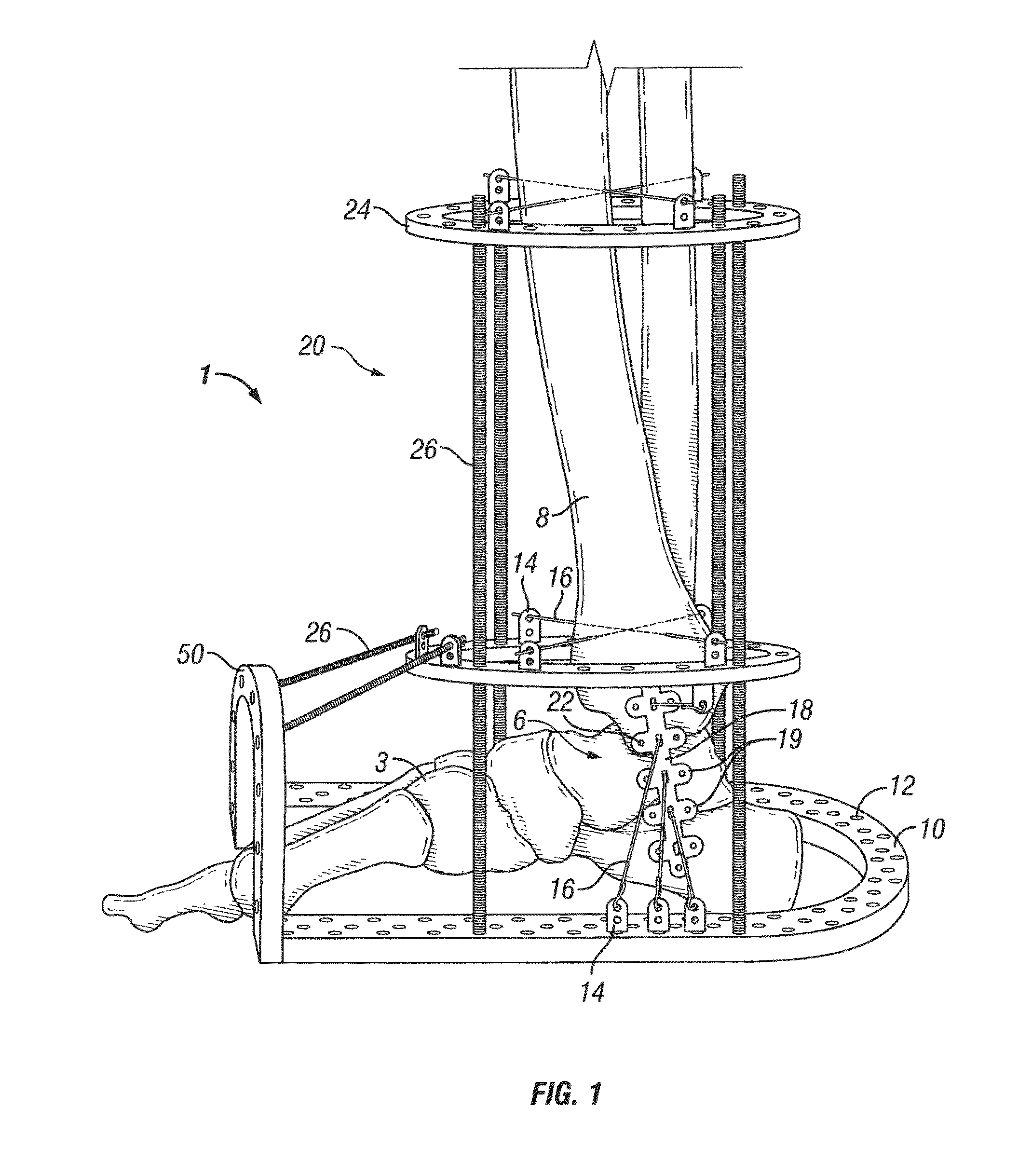 Foot, ankle and lower extremity compression and fixation system and related uses