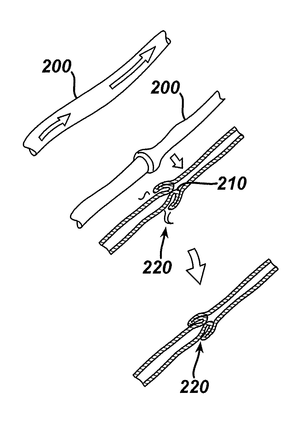 Method of Filling an Intraluminal Reservoir with a Therapeutic Substance