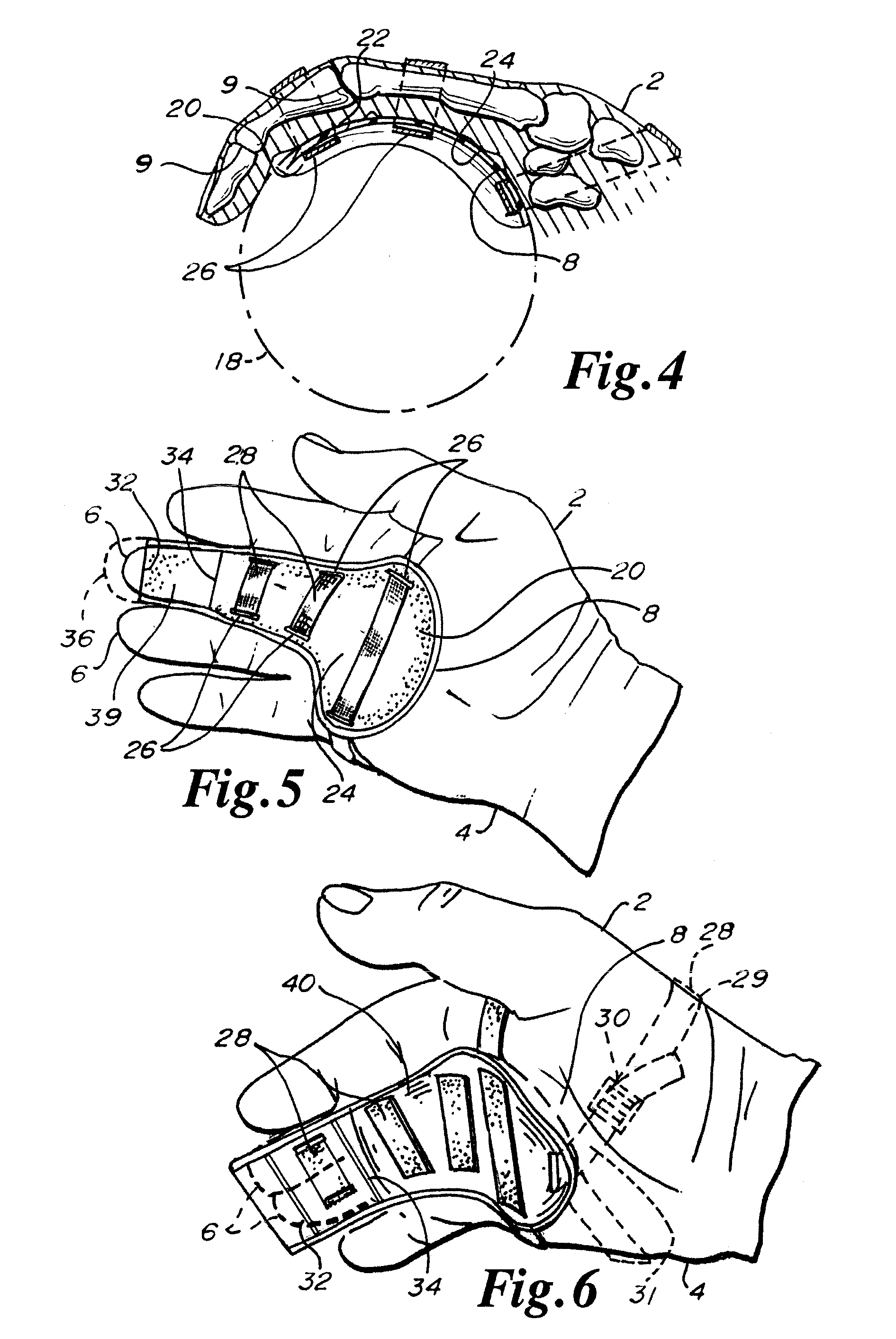 Spherical section hand splint