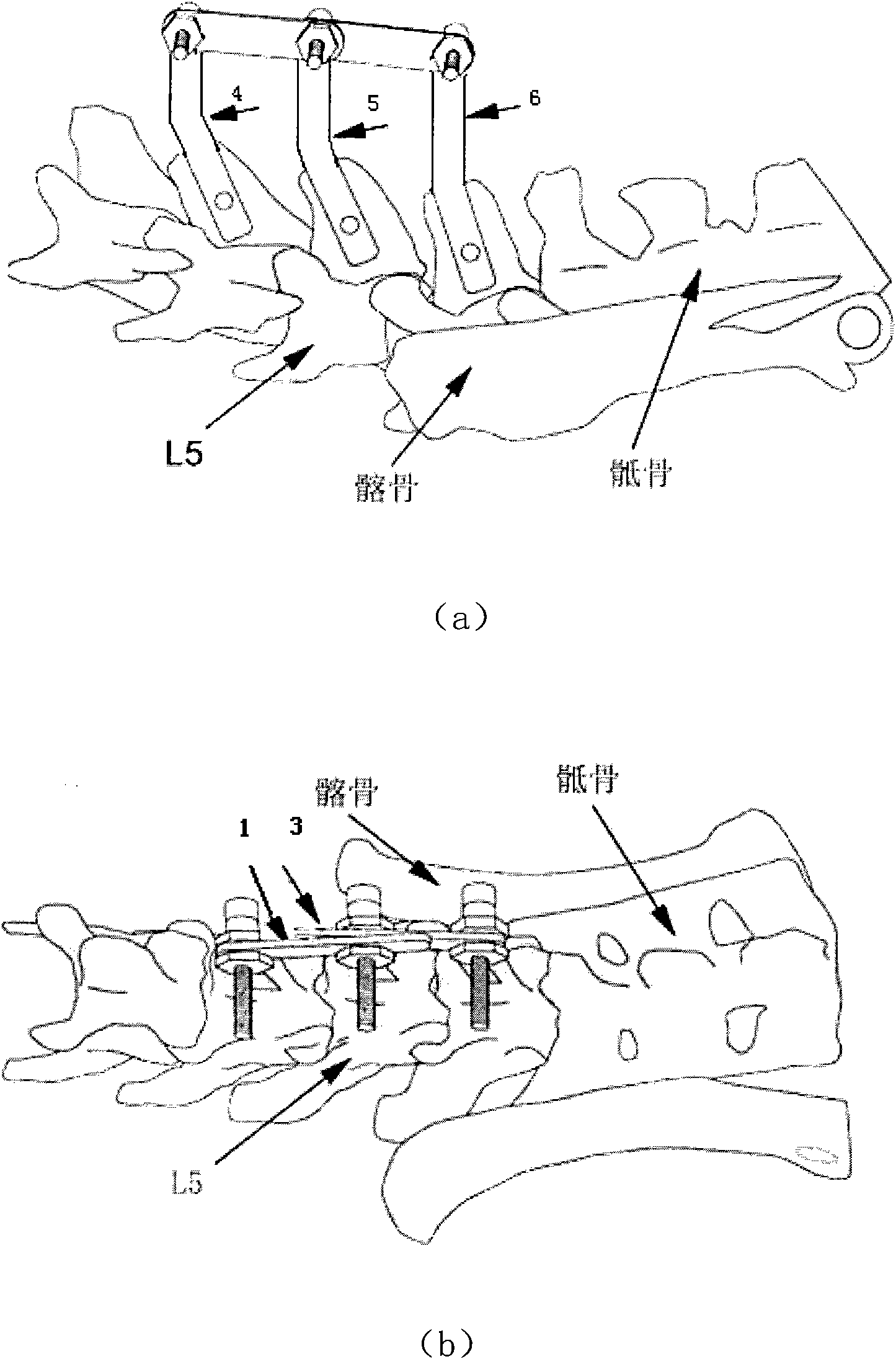 External connection fixing device for manufacturing rat spine subluxation animal model