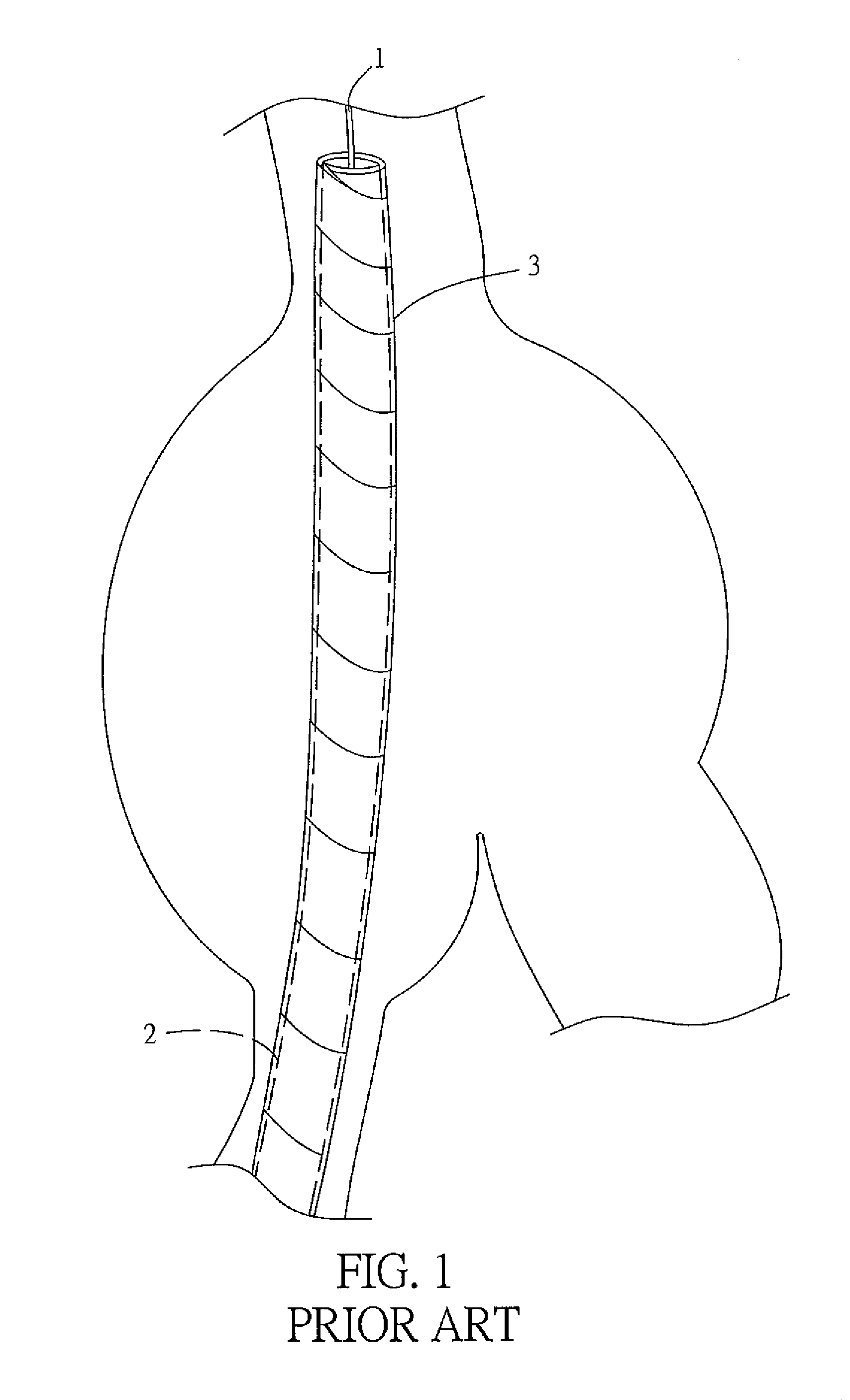 Abdominal aortic stent