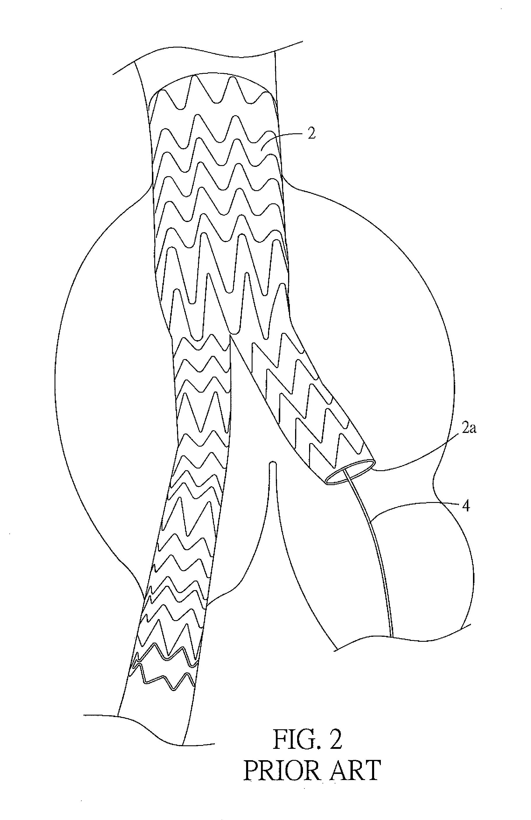 Abdominal aortic stent