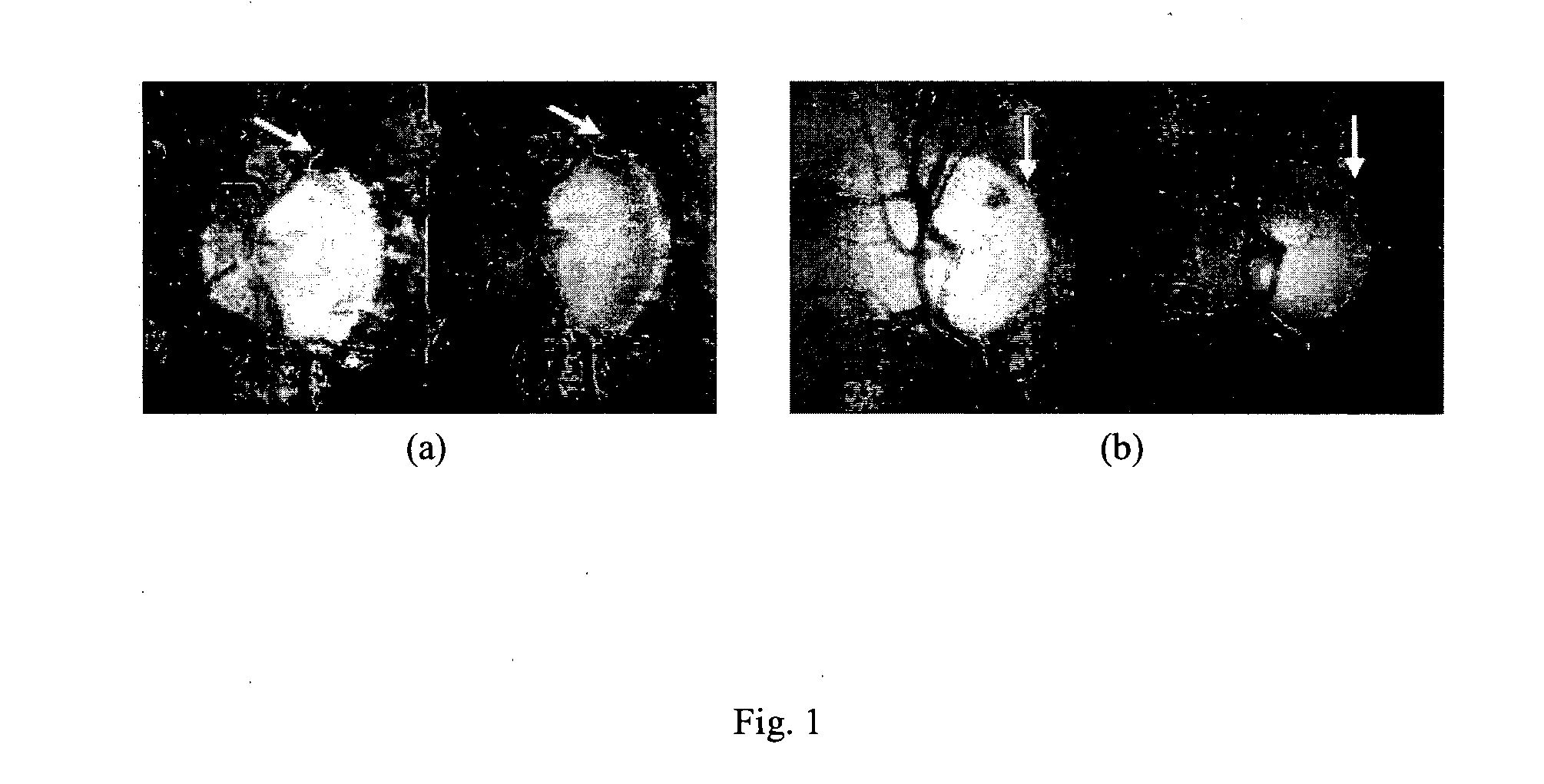 Method and system for detecting disc haemorrhages
