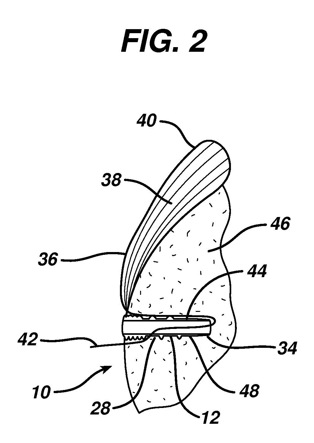 Knotless suture anchor and driver