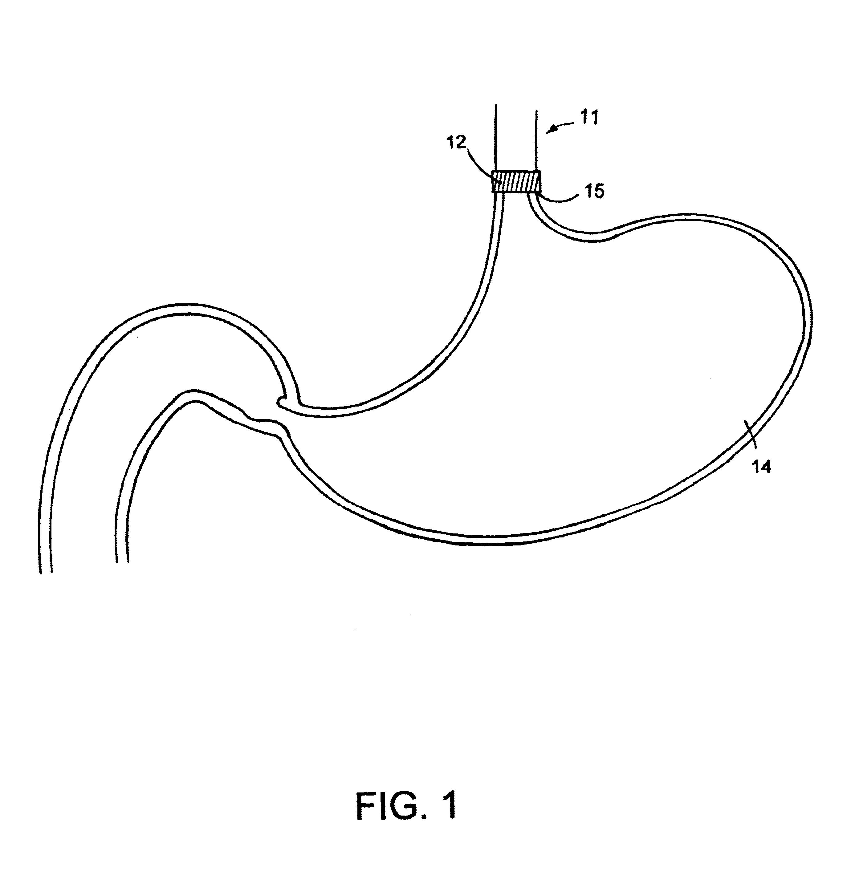 Method and apparatus for electrical stimulation of the lower esophageal sphincter