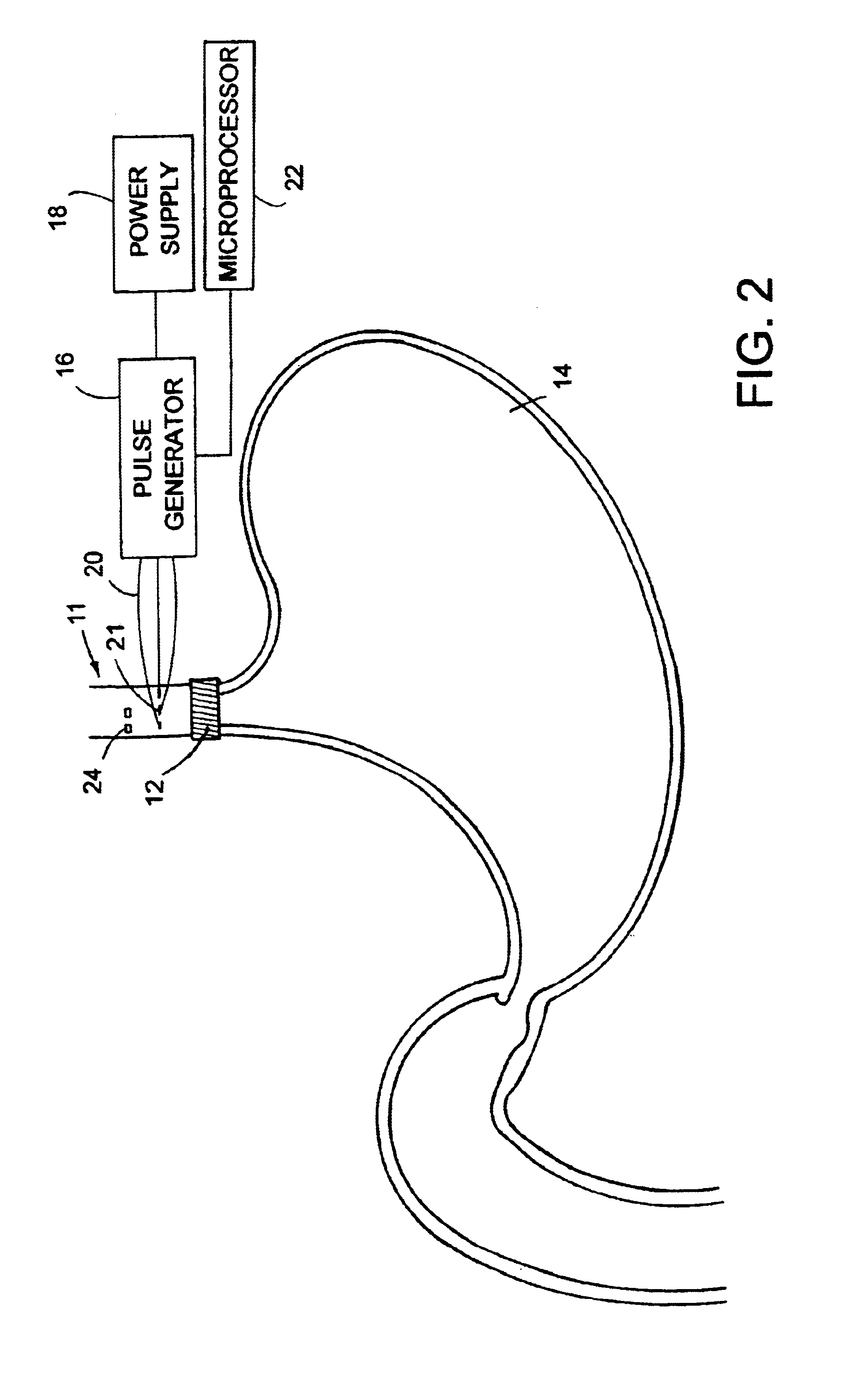 Method and apparatus for electrical stimulation of the lower esophageal sphincter