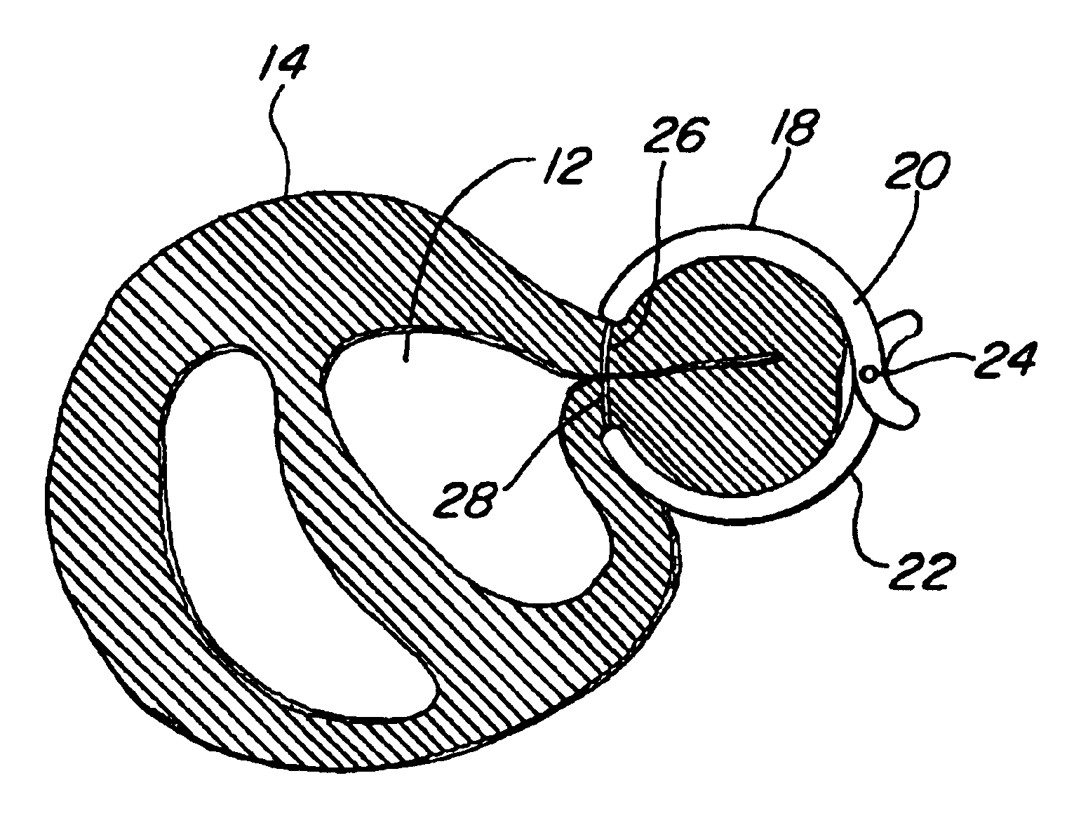 Device and method for treatment of congestive heart failure