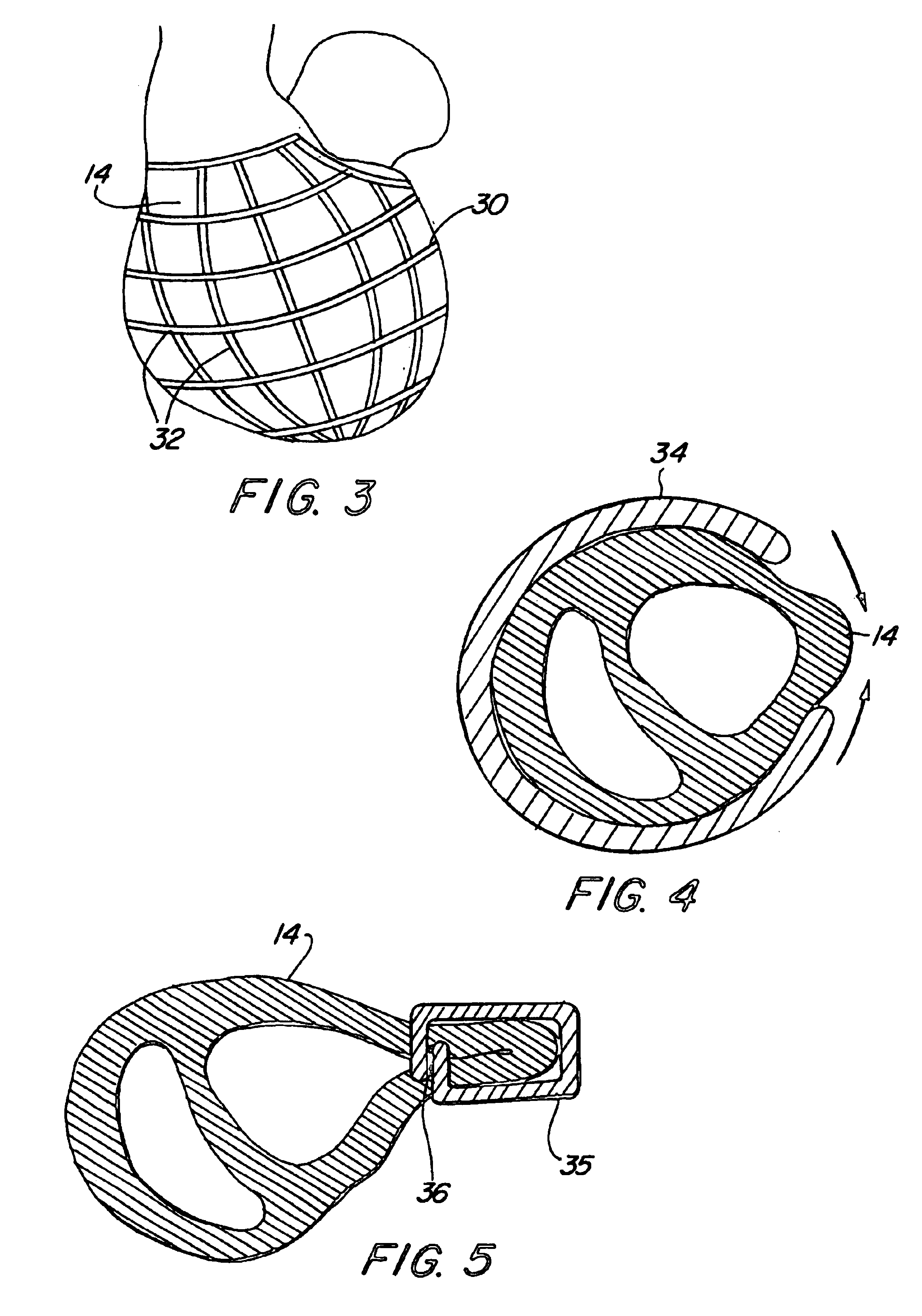 Device and method for treatment of congestive heart failure