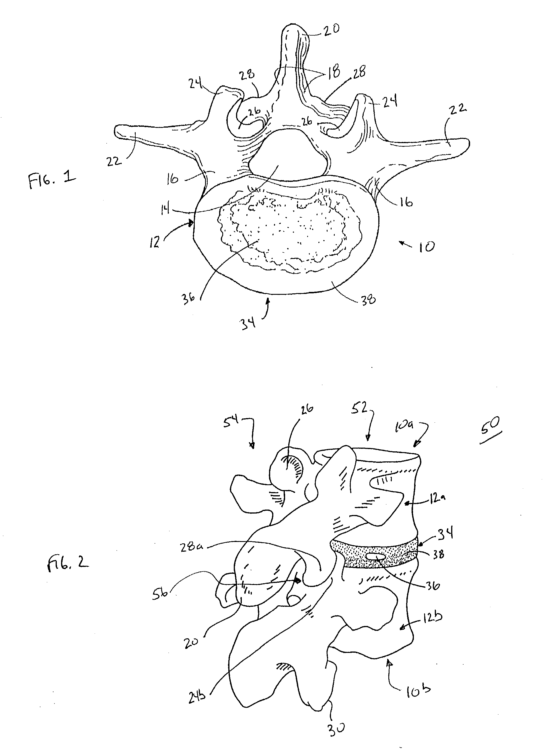 Systems and methods for stabilizing a functional spinal unit