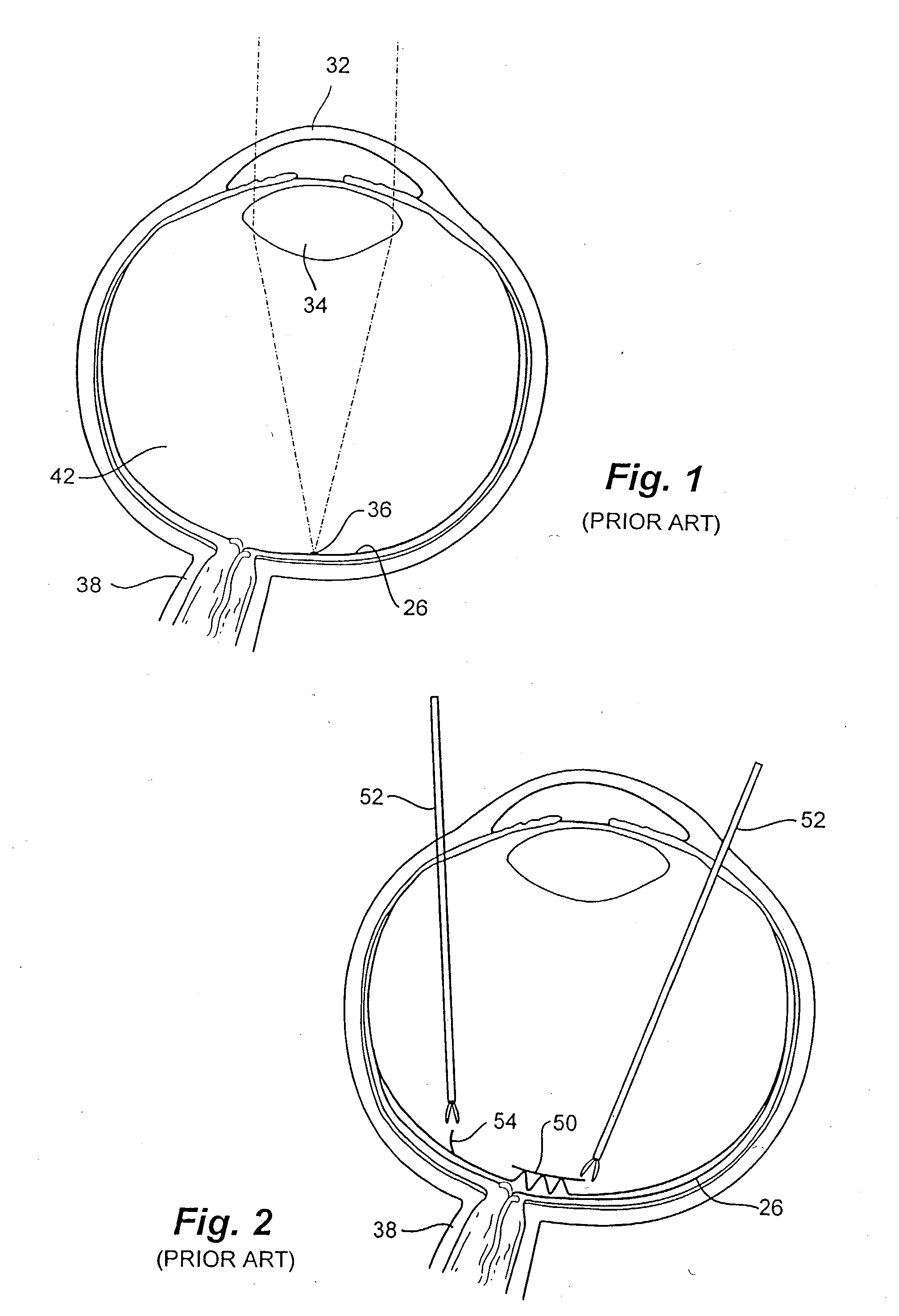 Apparatus for performing surgery inside the human retina using fluidic internal limiting membrane (ILM) separation (FILMS)