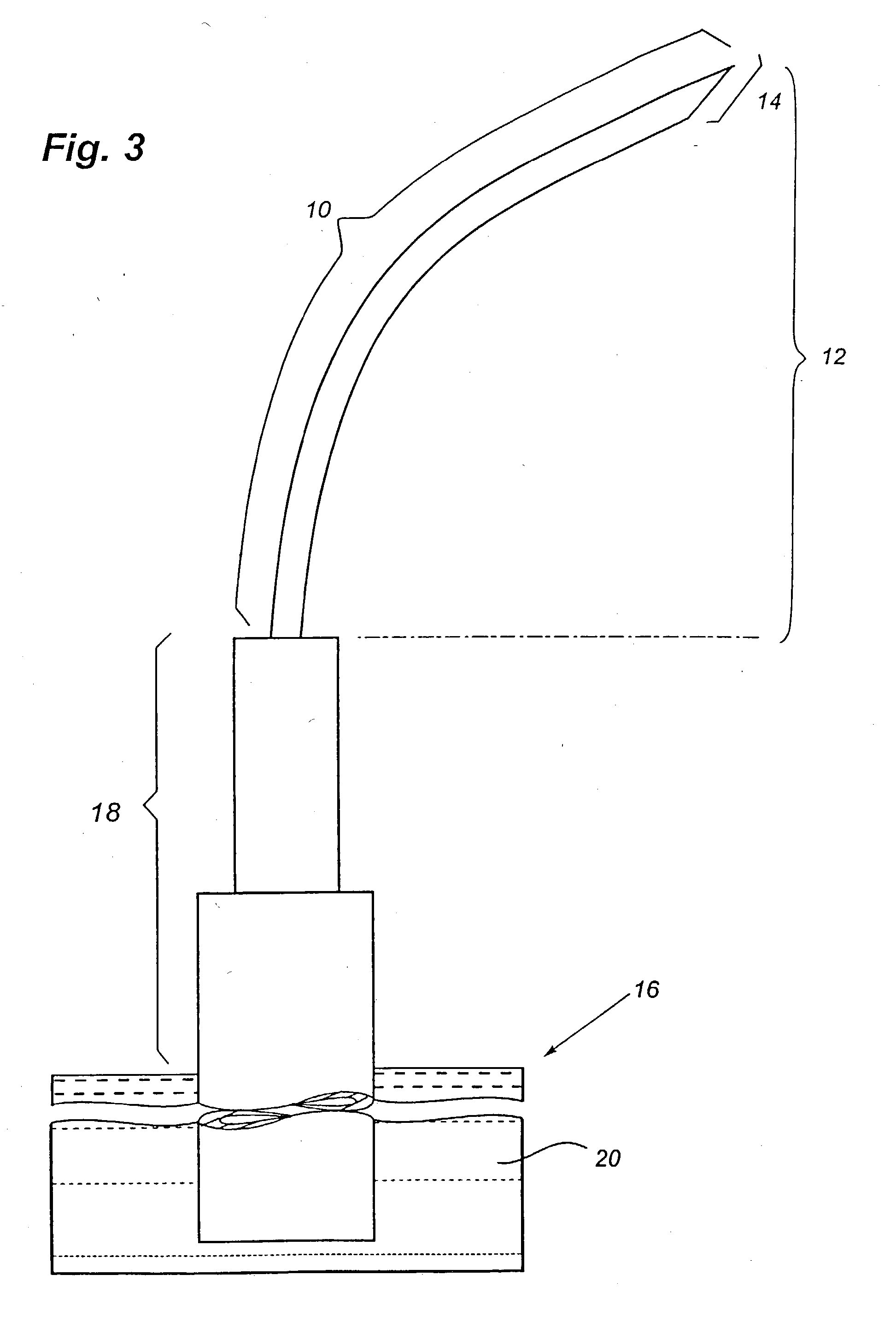 Apparatus for performing surgery inside the human retina using fluidic internal limiting membrane (ILM) separation (FILMS)