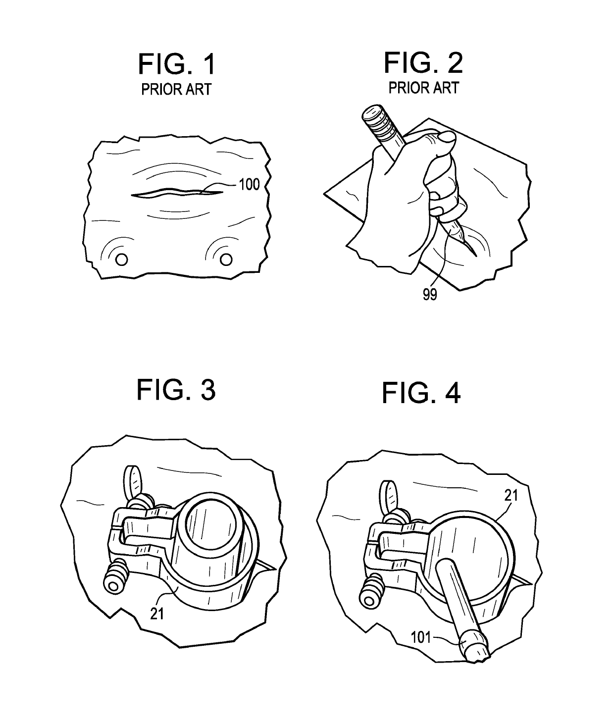 Method and instruments for interbody fusion and posterior fixation through a single incision