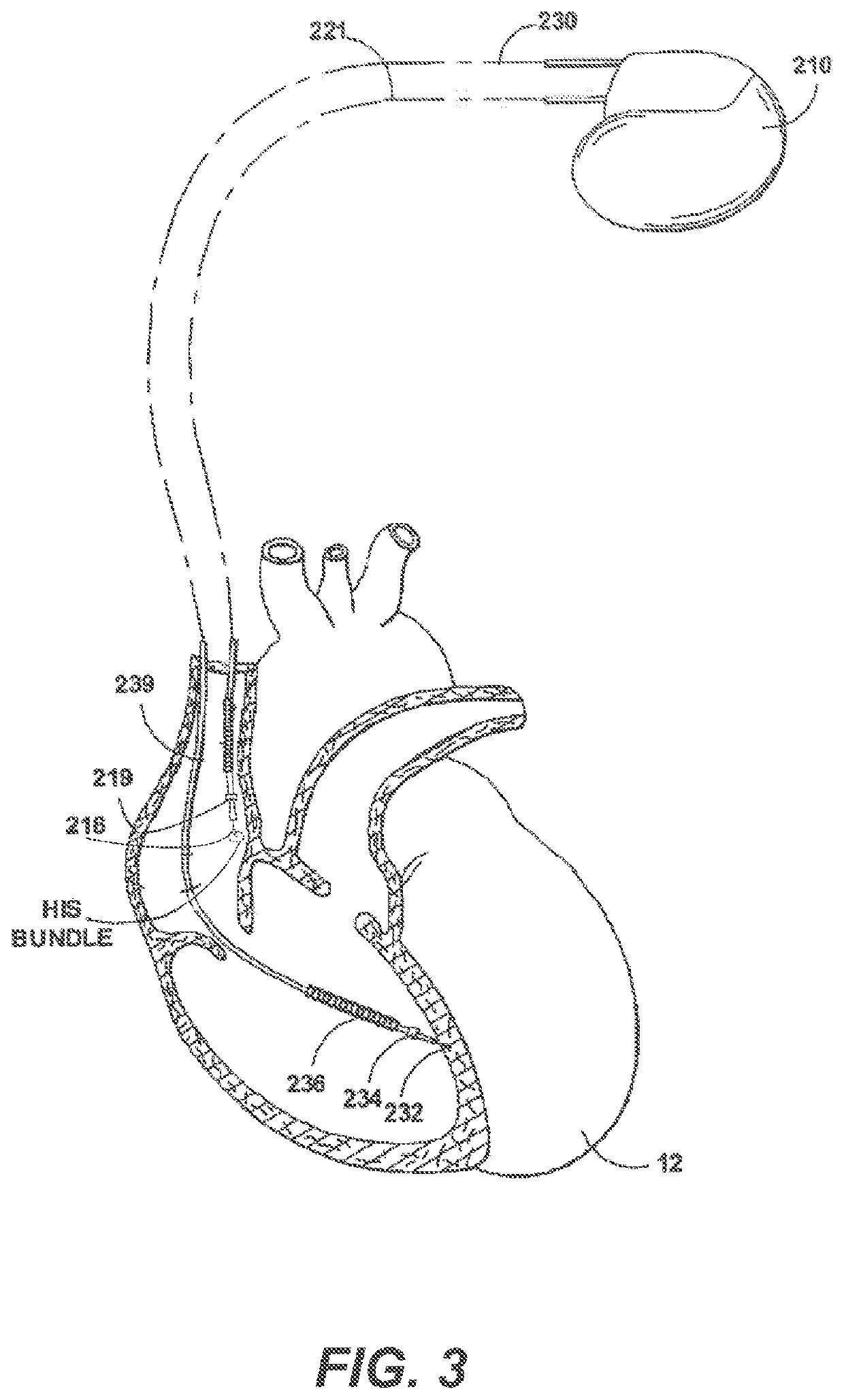 Systems and methods for automated capture threshold testing and associated his bundle pacing