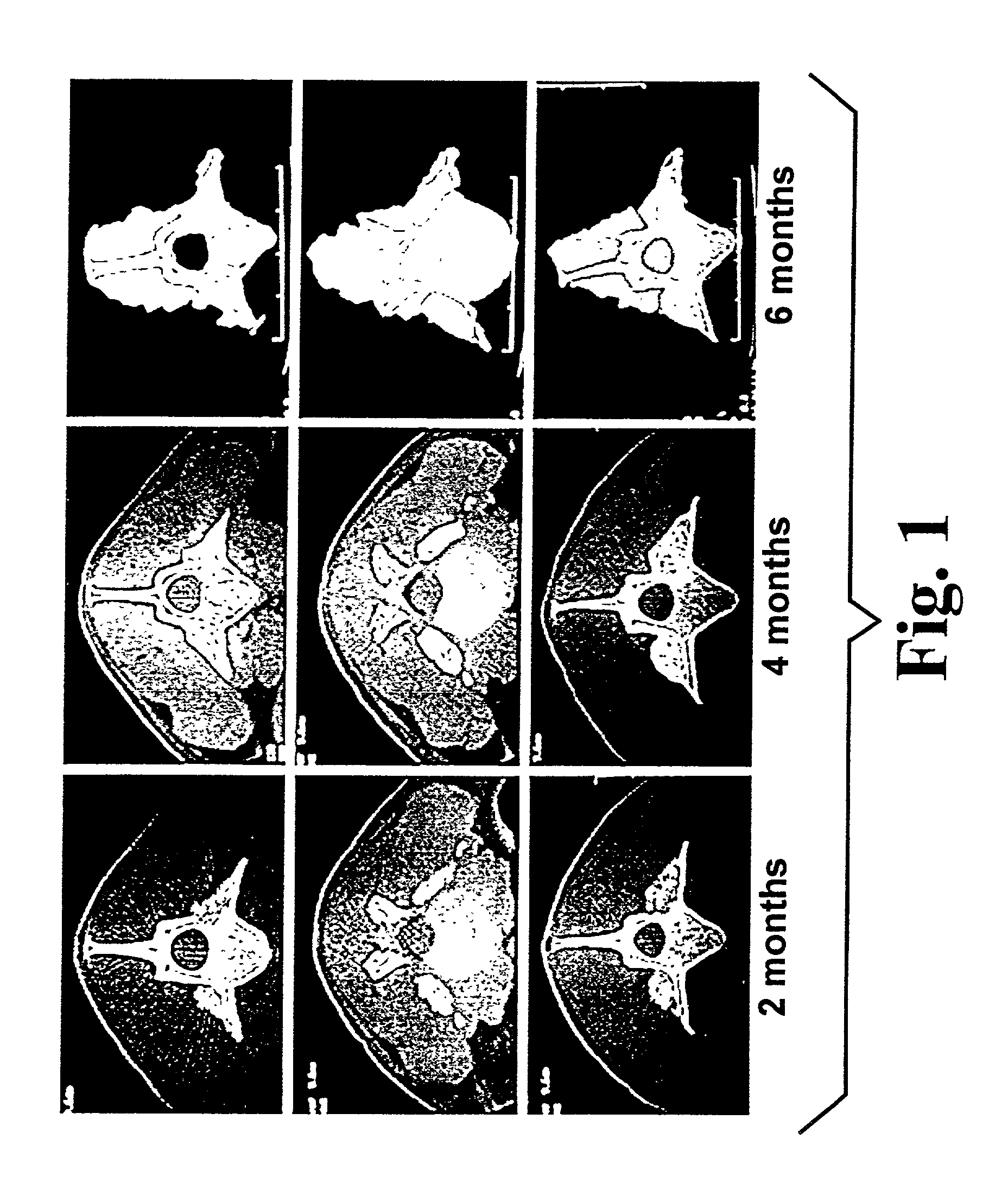 Highly-mineralized osteogenic sponge compositions, and uses thereof