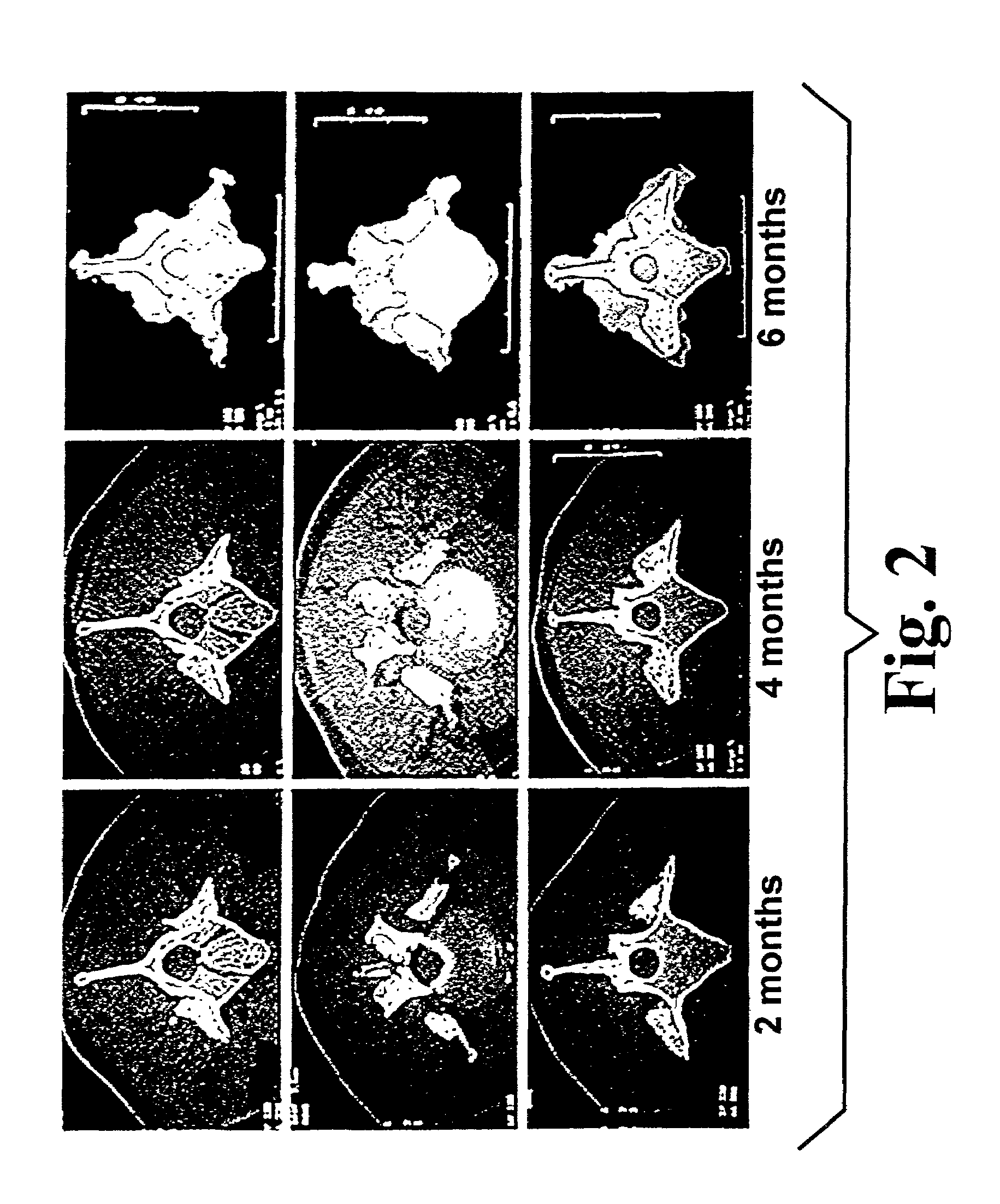 Highly-mineralized osteogenic sponge compositions, and uses thereof