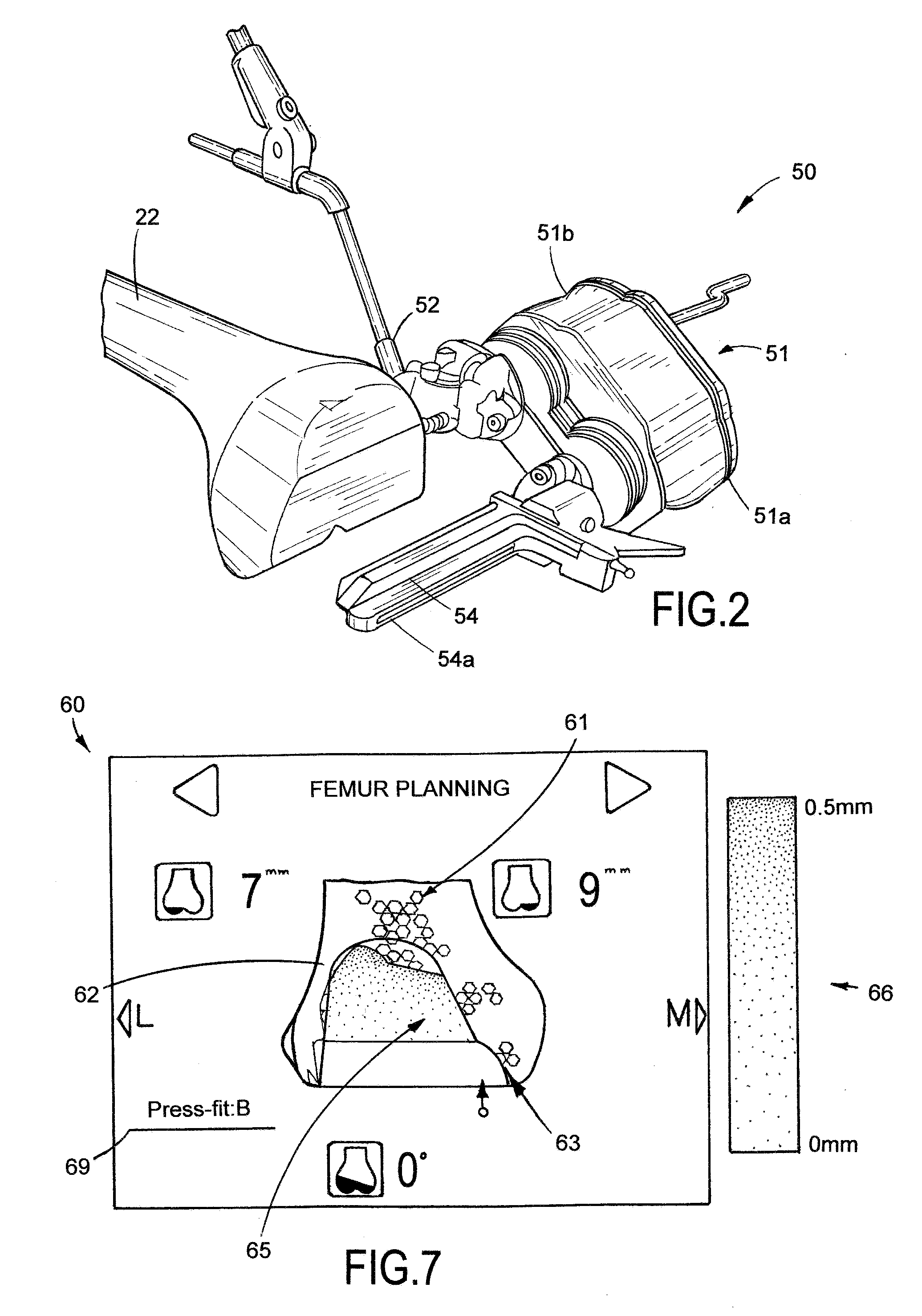 System and method for bone preparation for an implant