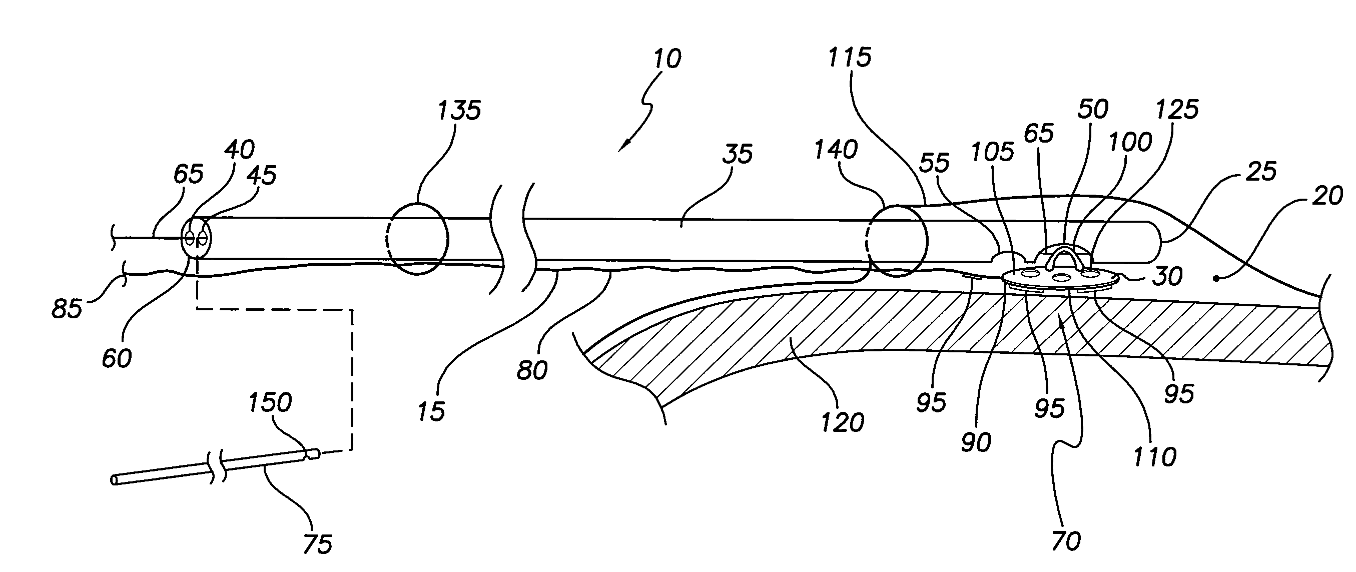 System and method for lead implantation in a pericardial space