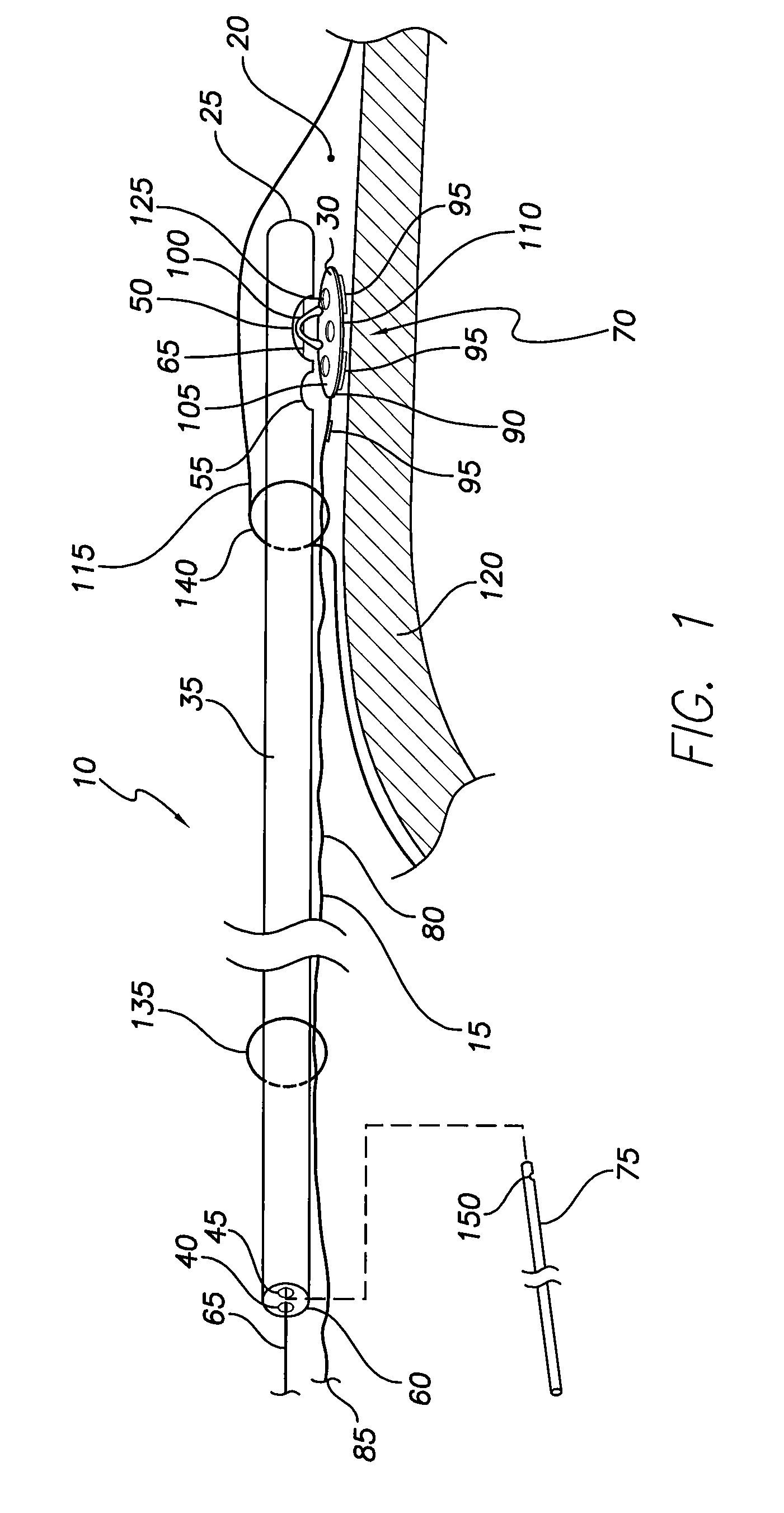 System and method for lead implantation in a pericardial space
