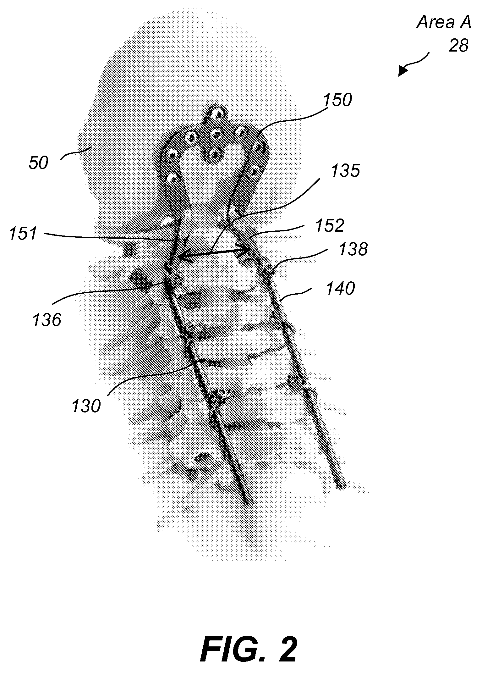 Apparatus and method for spine fixation