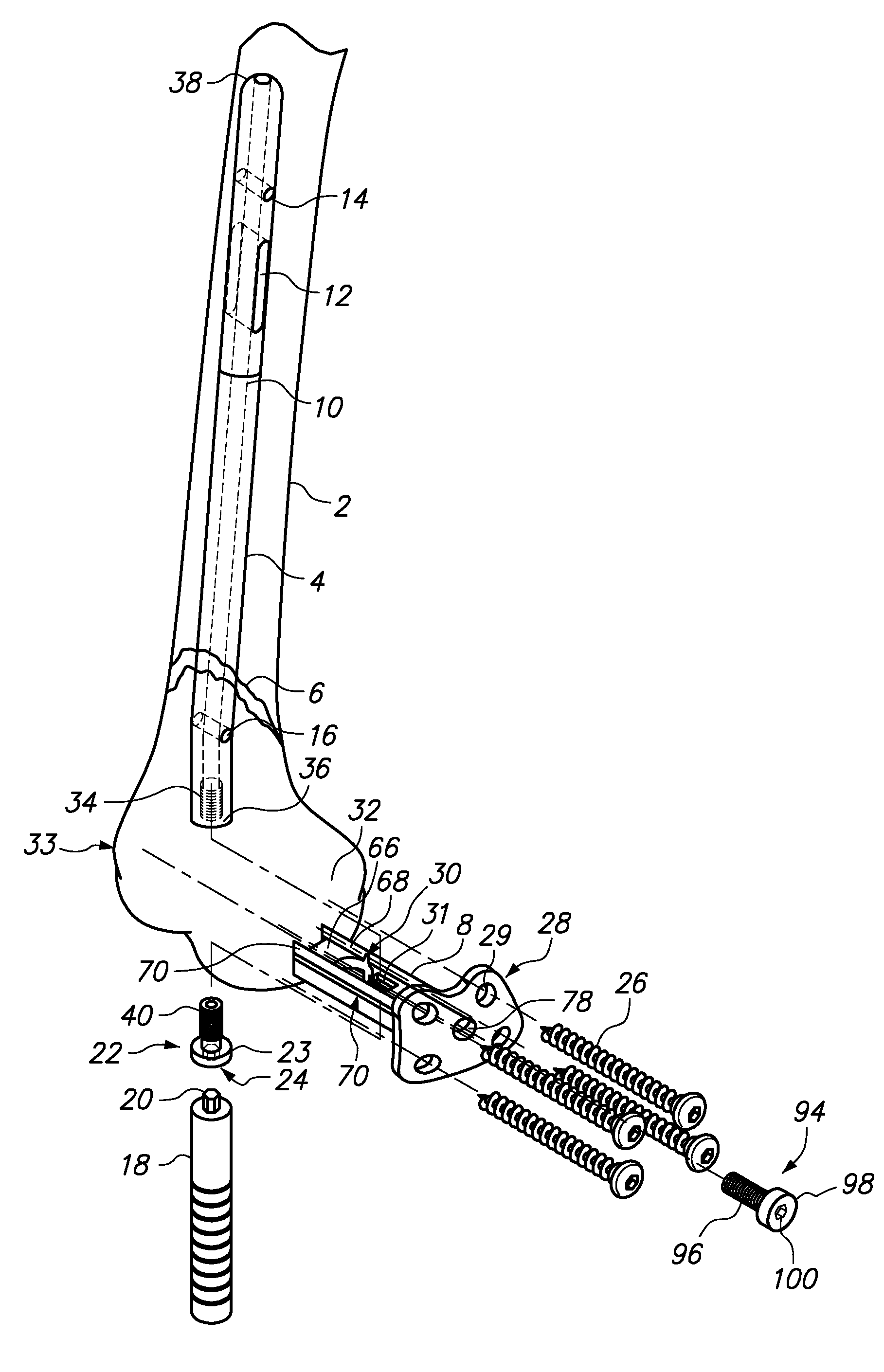 Bone Fixation Assemblies and Methods of Use
