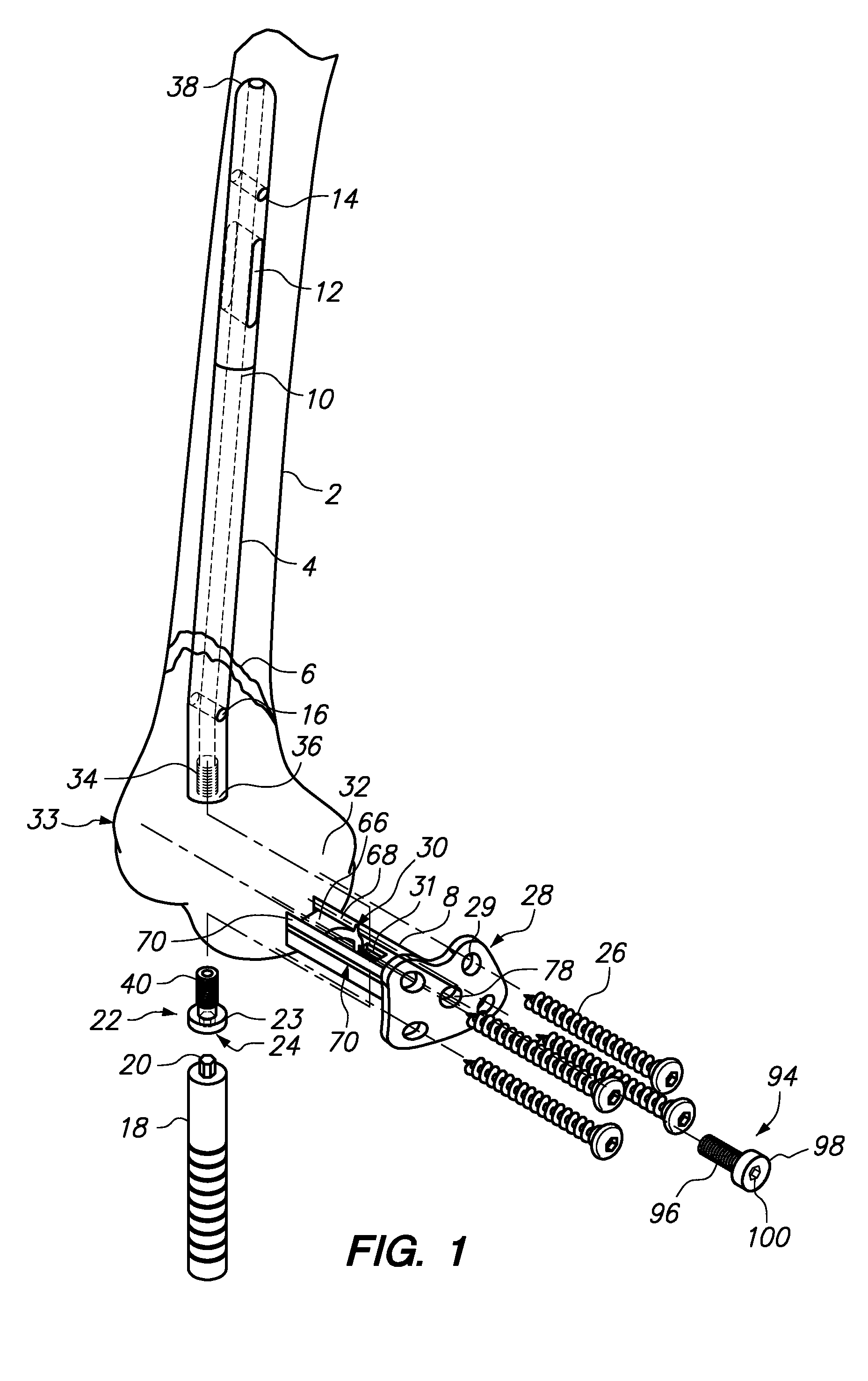 Bone Fixation Assemblies and Methods of Use