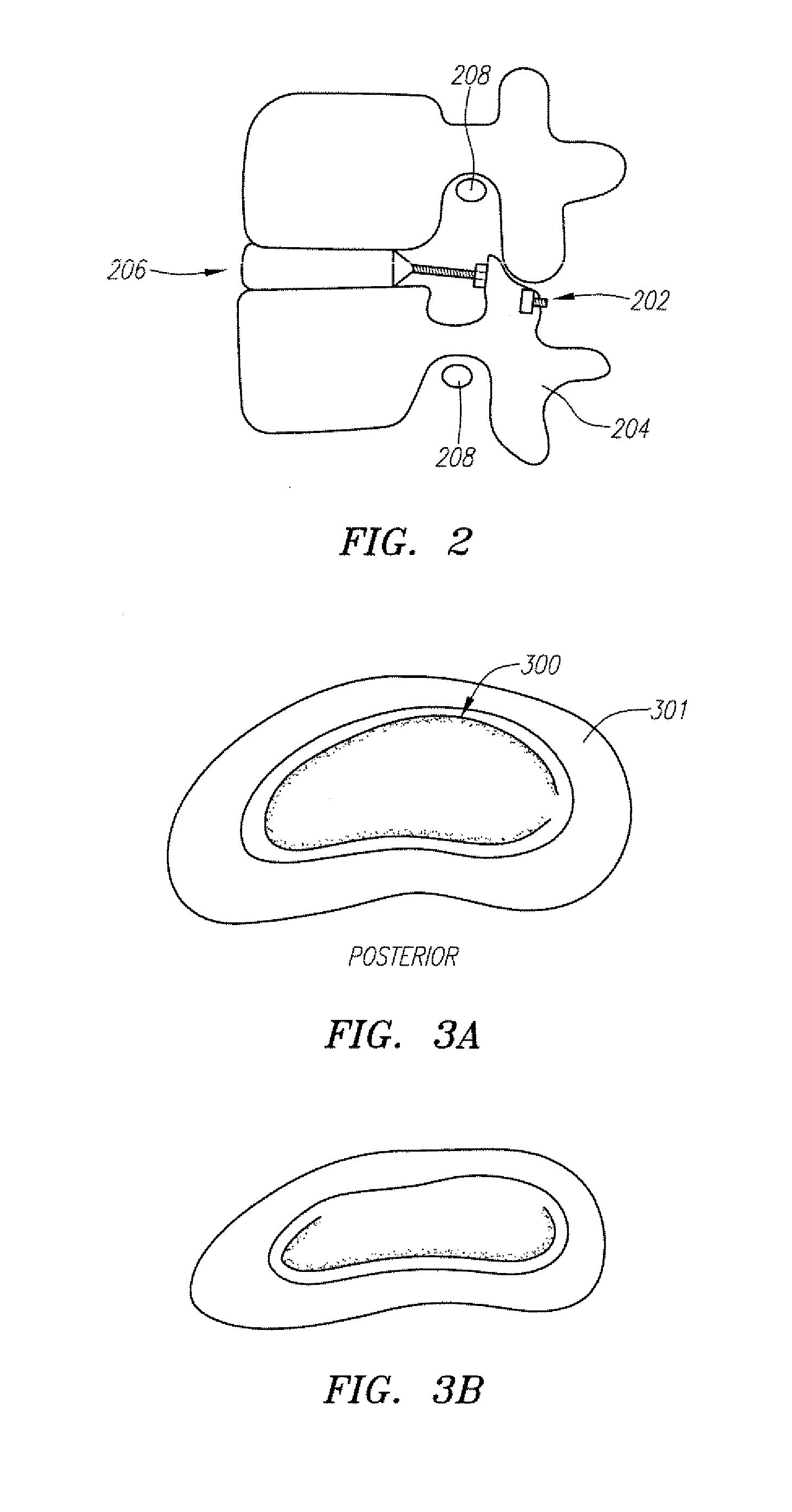 Devices used to treat disc herniation and attachment mechanisms therefore