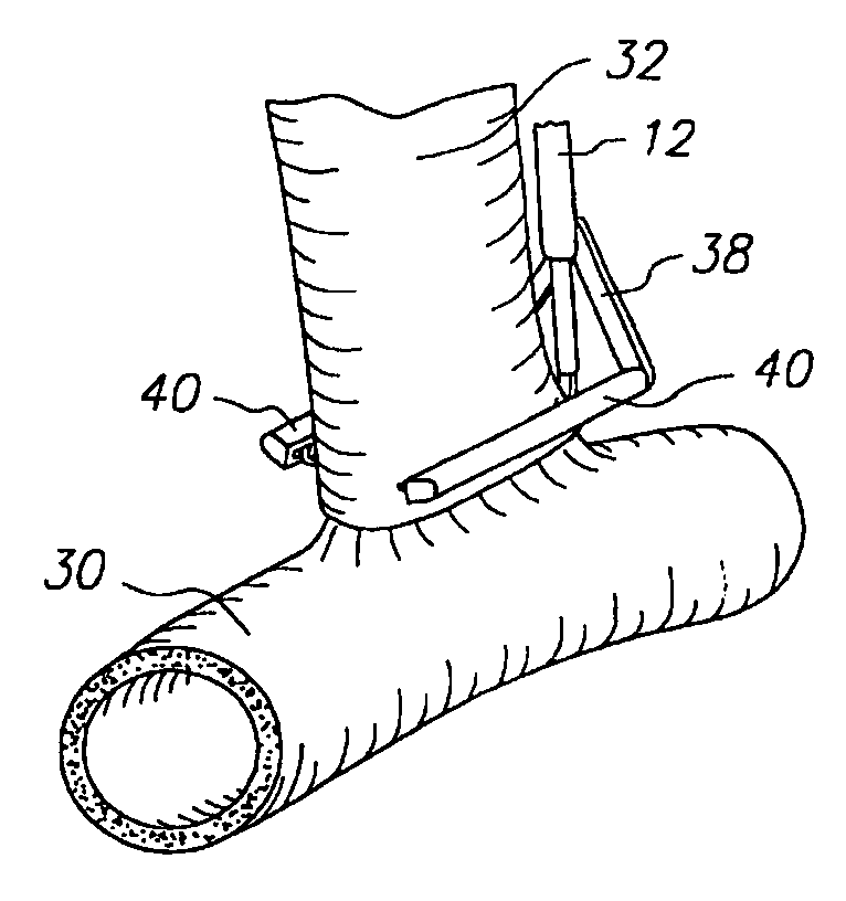 Apparatus for performing anastomosis