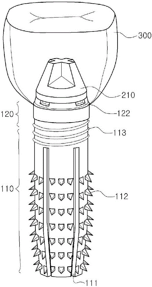Spike-fixing type implant and method for implanting same
