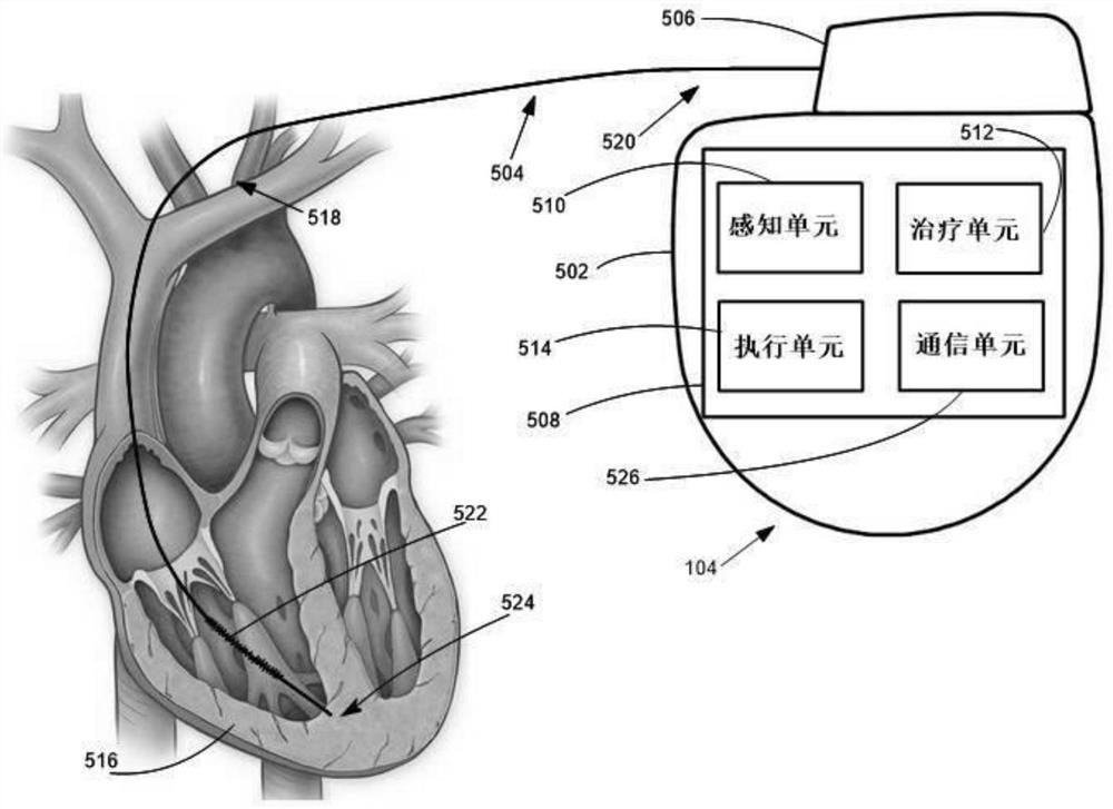 Implementable medical equipment with ventricular tachycardia diagnosis function