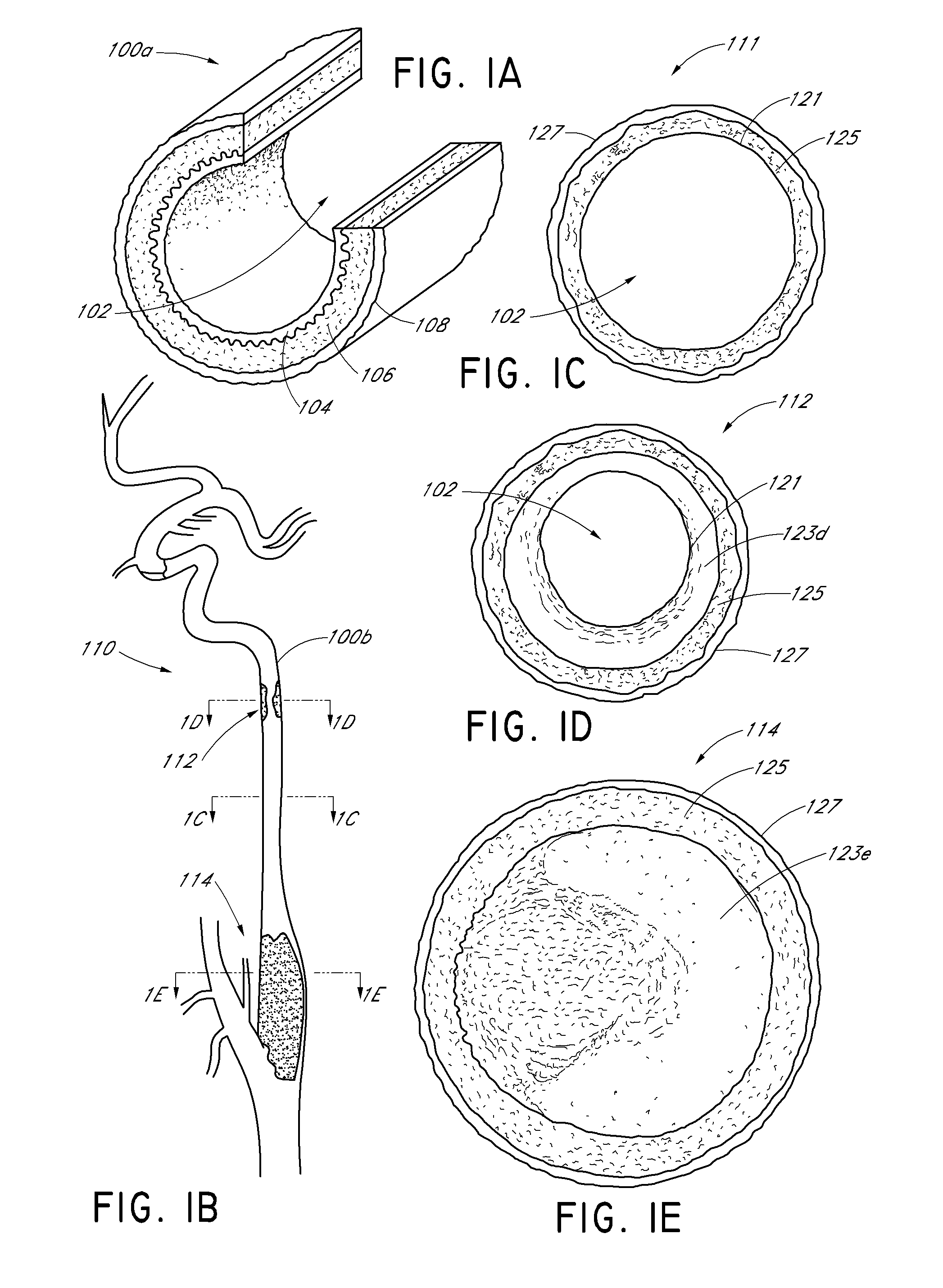 Vascular plaque removal systems, devices, and methods