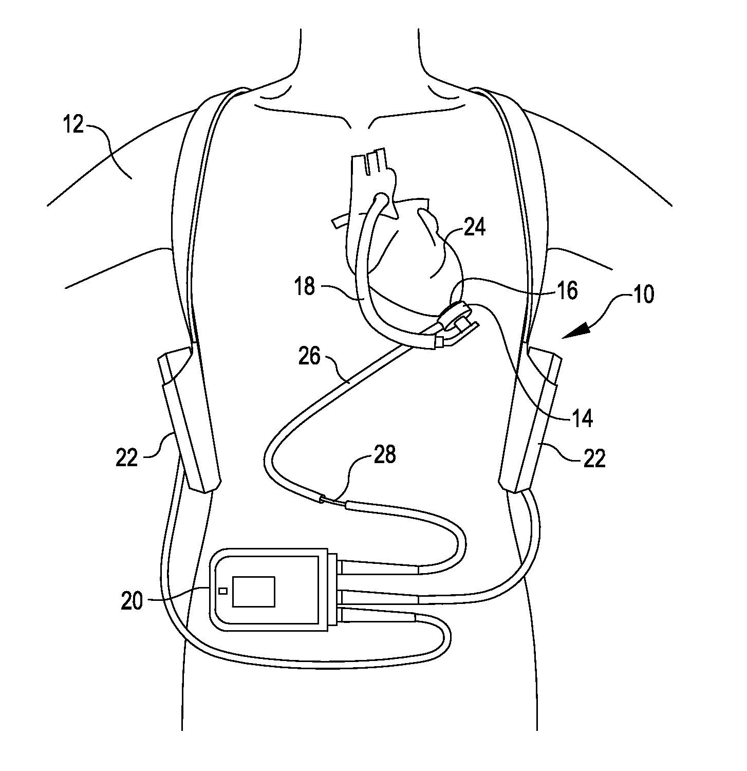 Methods and systems for providing battery feedback to patient
