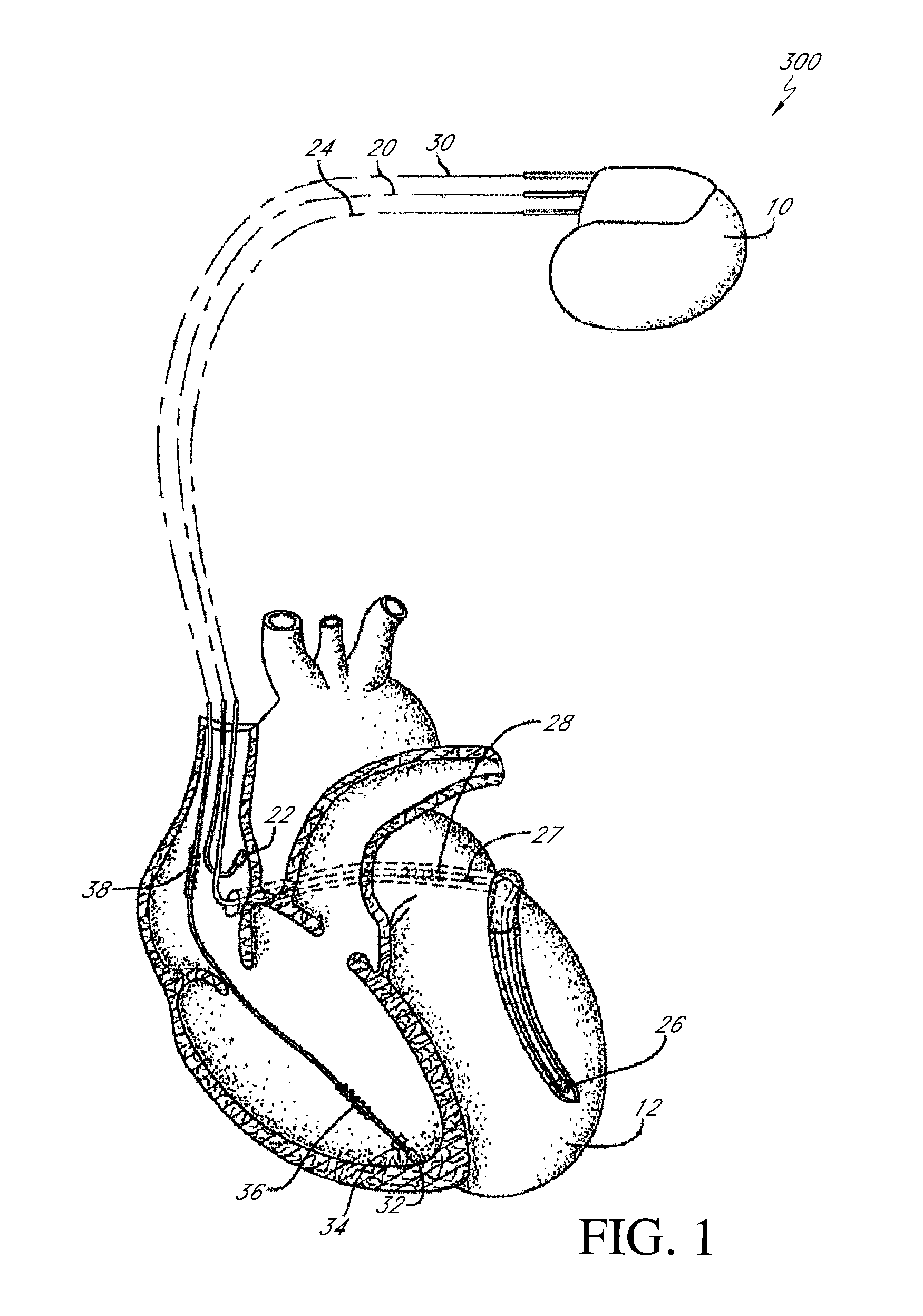 System to create arbitrary waveforms using an external inductor and an implantable medical device