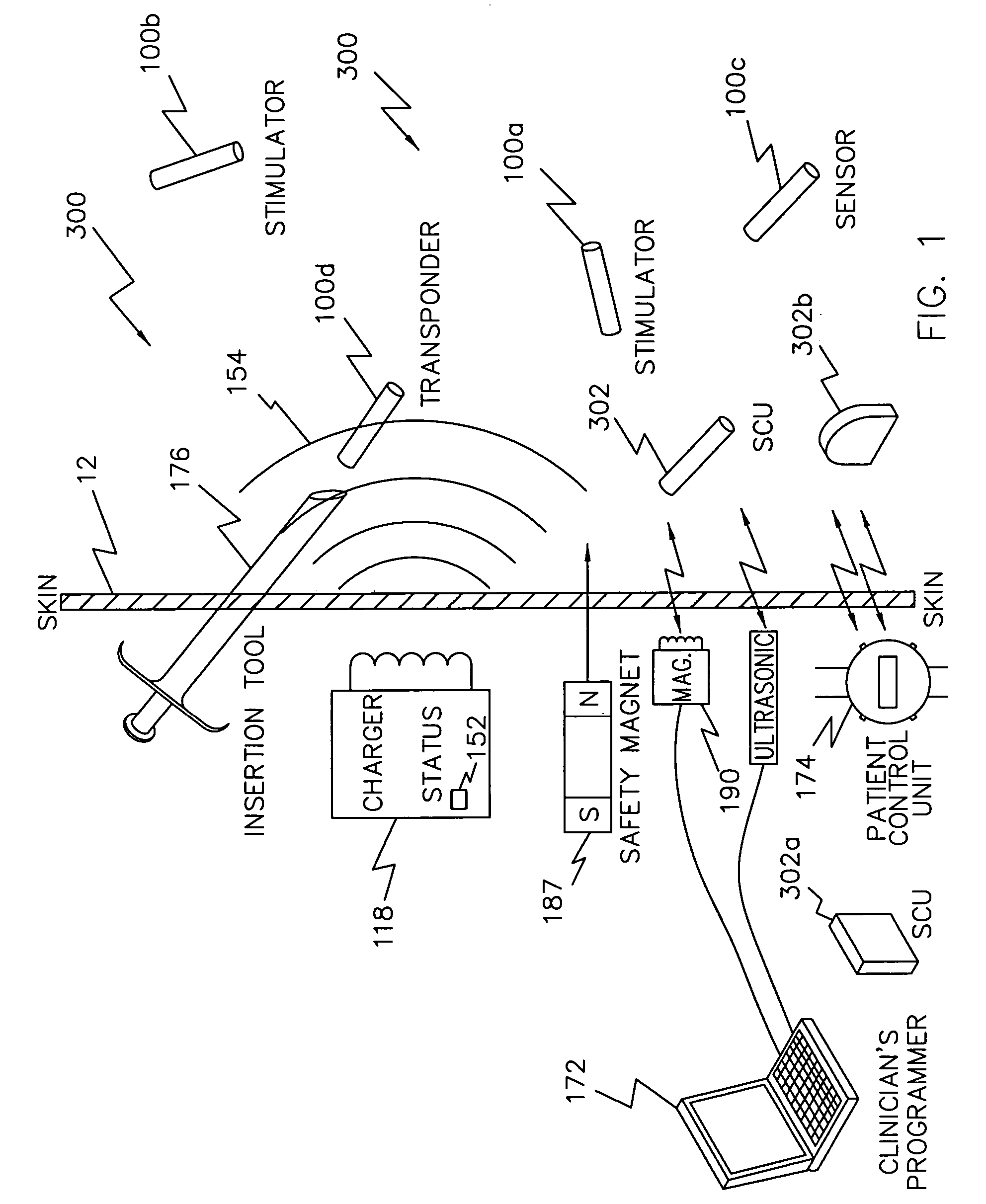 System and method suitable for treatment of a patient with a neurological deficit by sequentially stimulating neural pathways using a system of discrete implantable medical devices