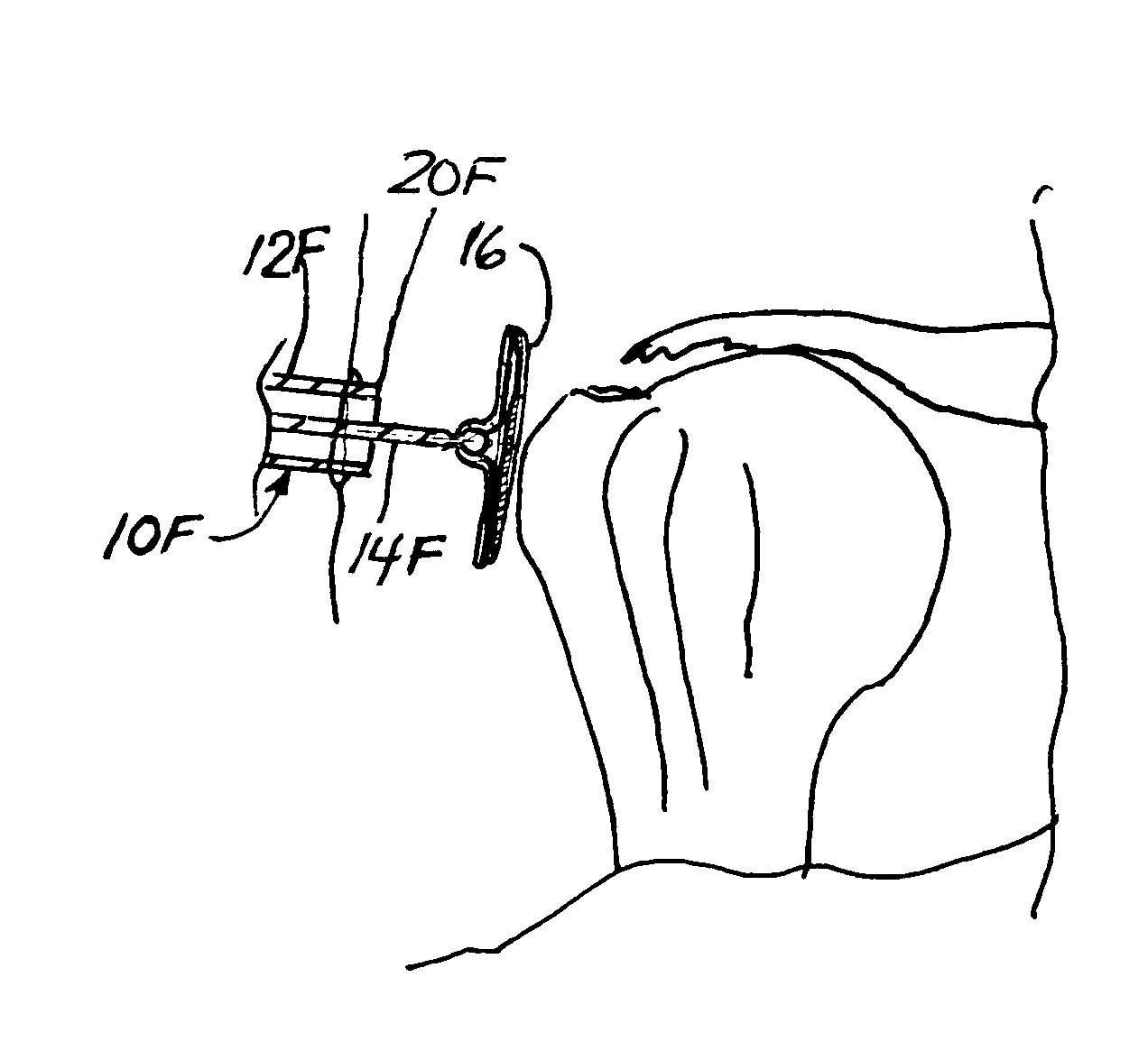 Implant delivery instrument