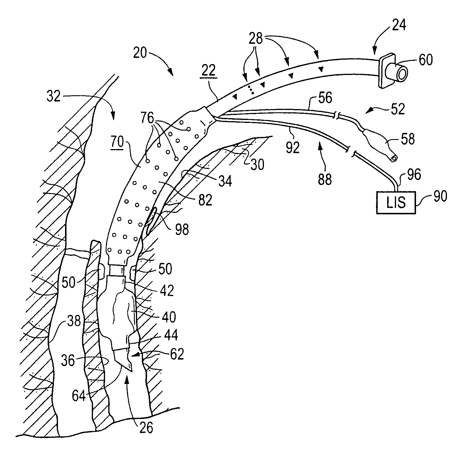 Endotracheal tube with suction attachment