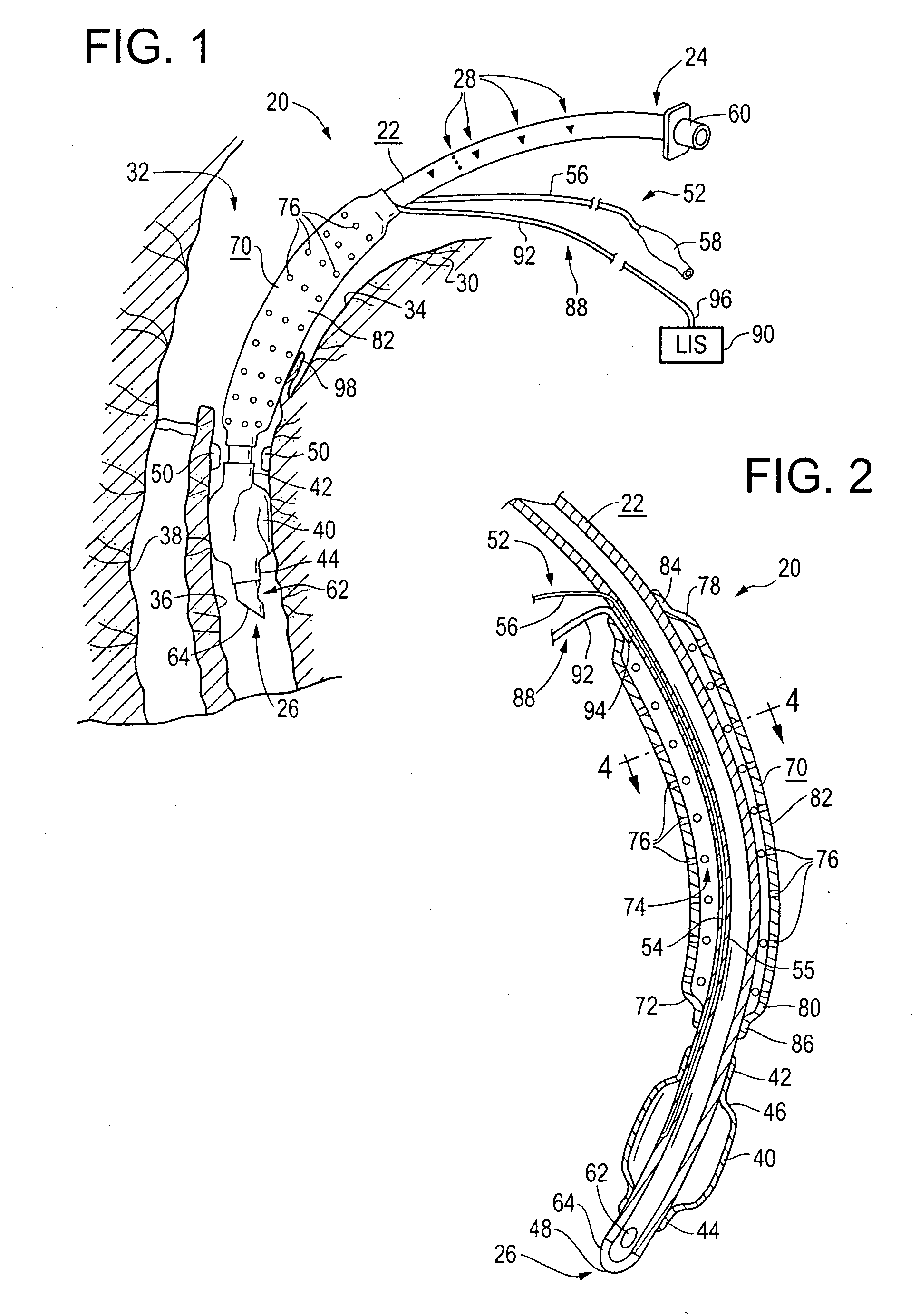 Endotracheal tube with suction attachment