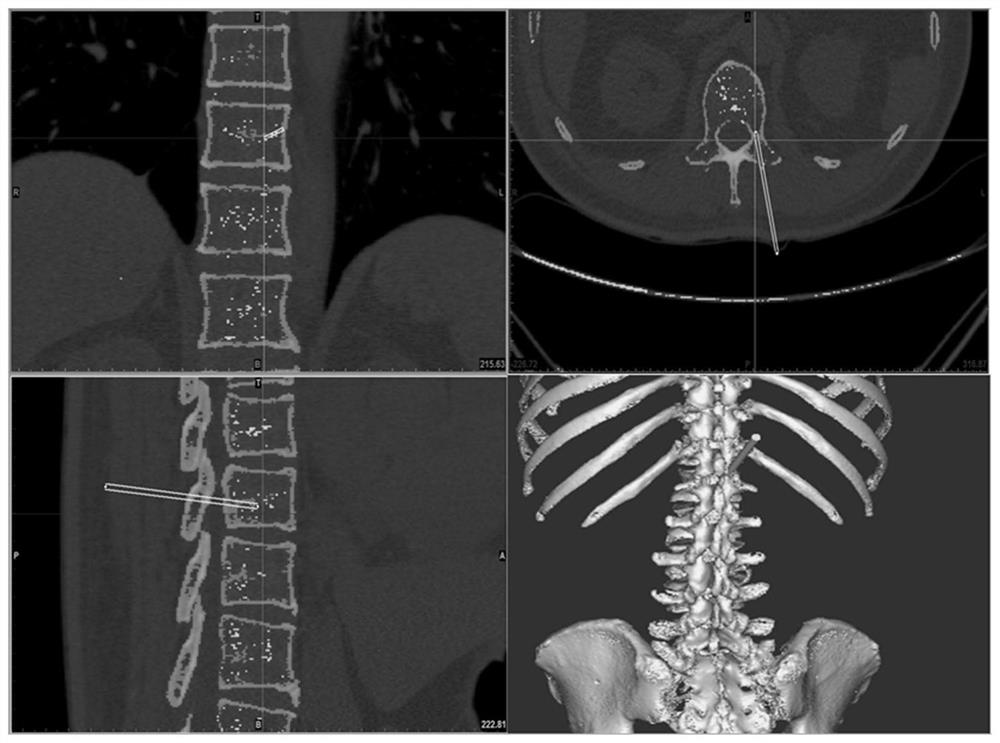 A navigation system for orthopedic surgery based on multimodal image fusion