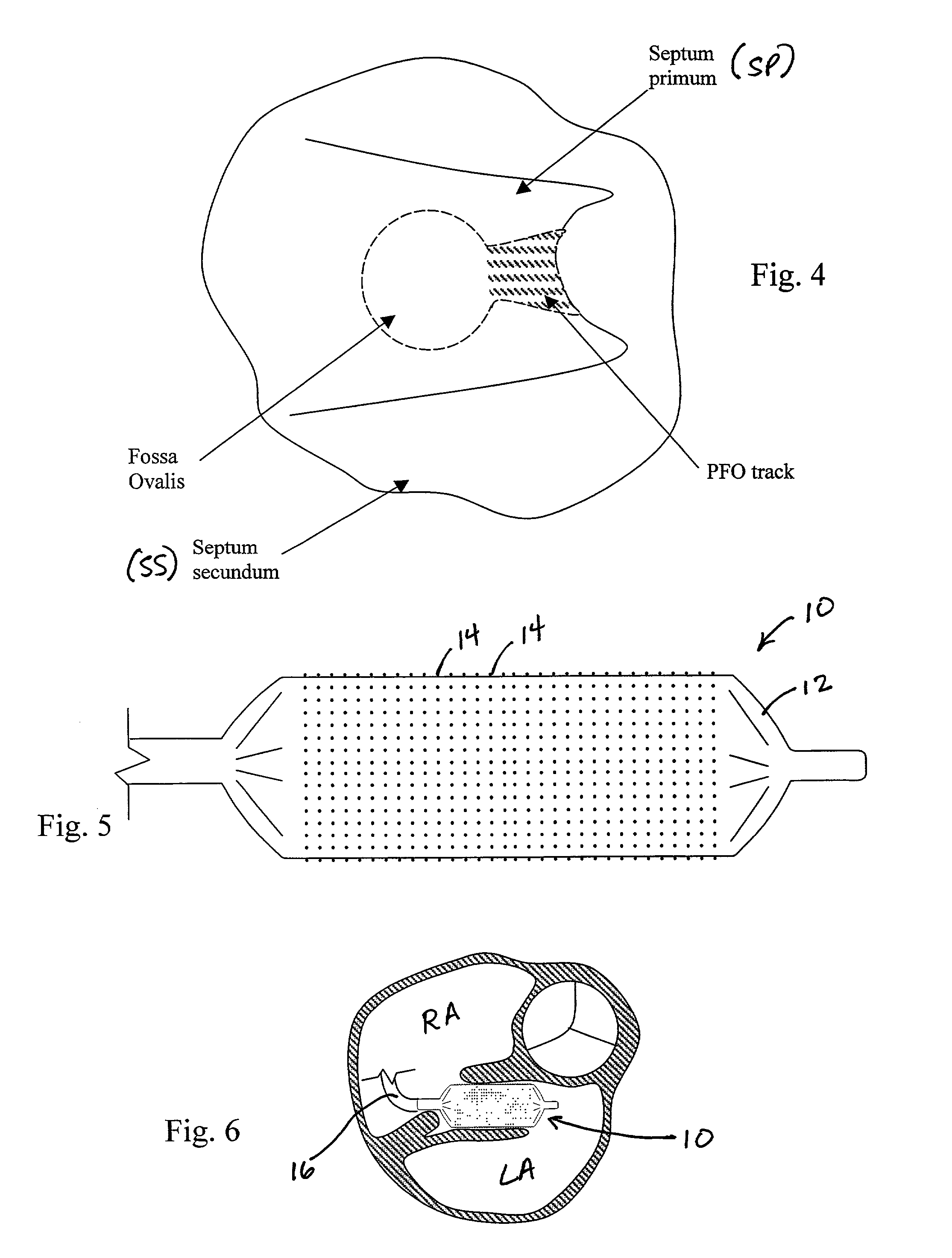 PFO closure devices and related methods of use