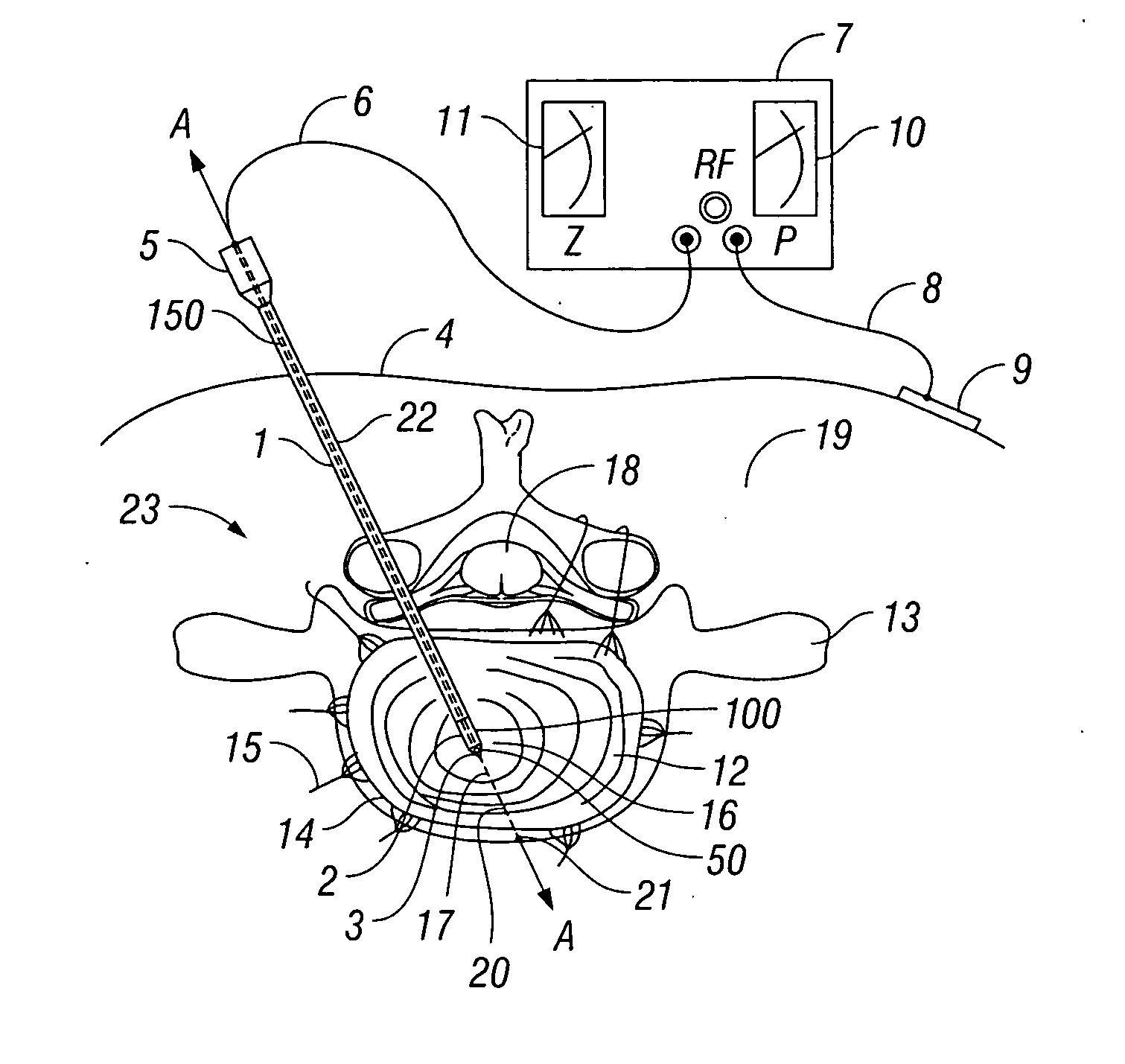 Method and apparatus for monitoring disc pressure during heat treatment of an intervertebral disc
