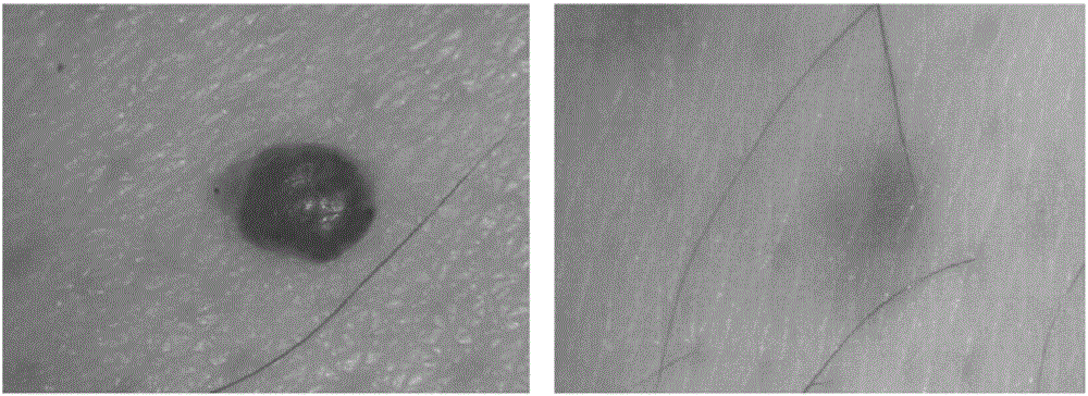 Treatment or prevention of seborrheic keratosis using artemisinin and derivatives thereof