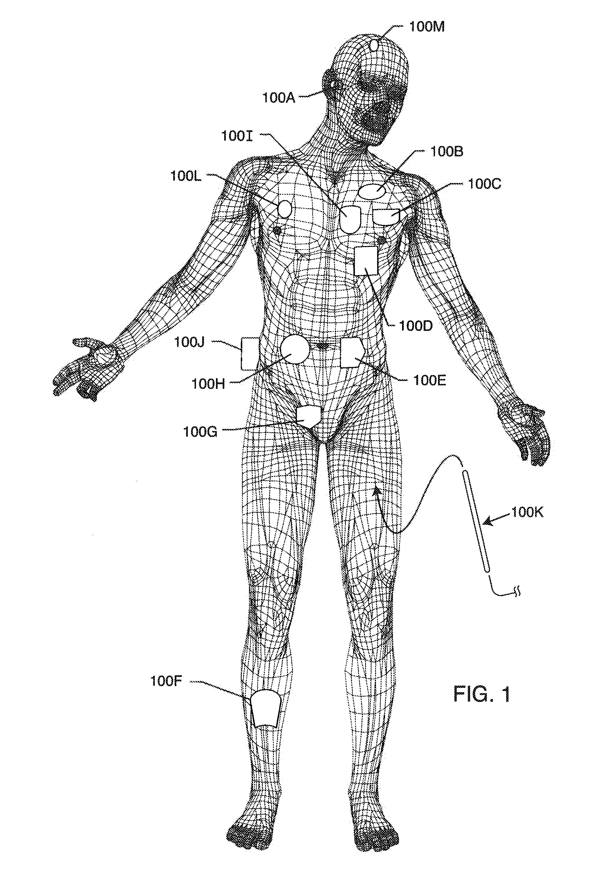 Elevated Hermetic Feedthrough Insulator Adapted for Side Attachment of Electrical Conductors on the Body Fluid Side of an Active Implantable Medical Device