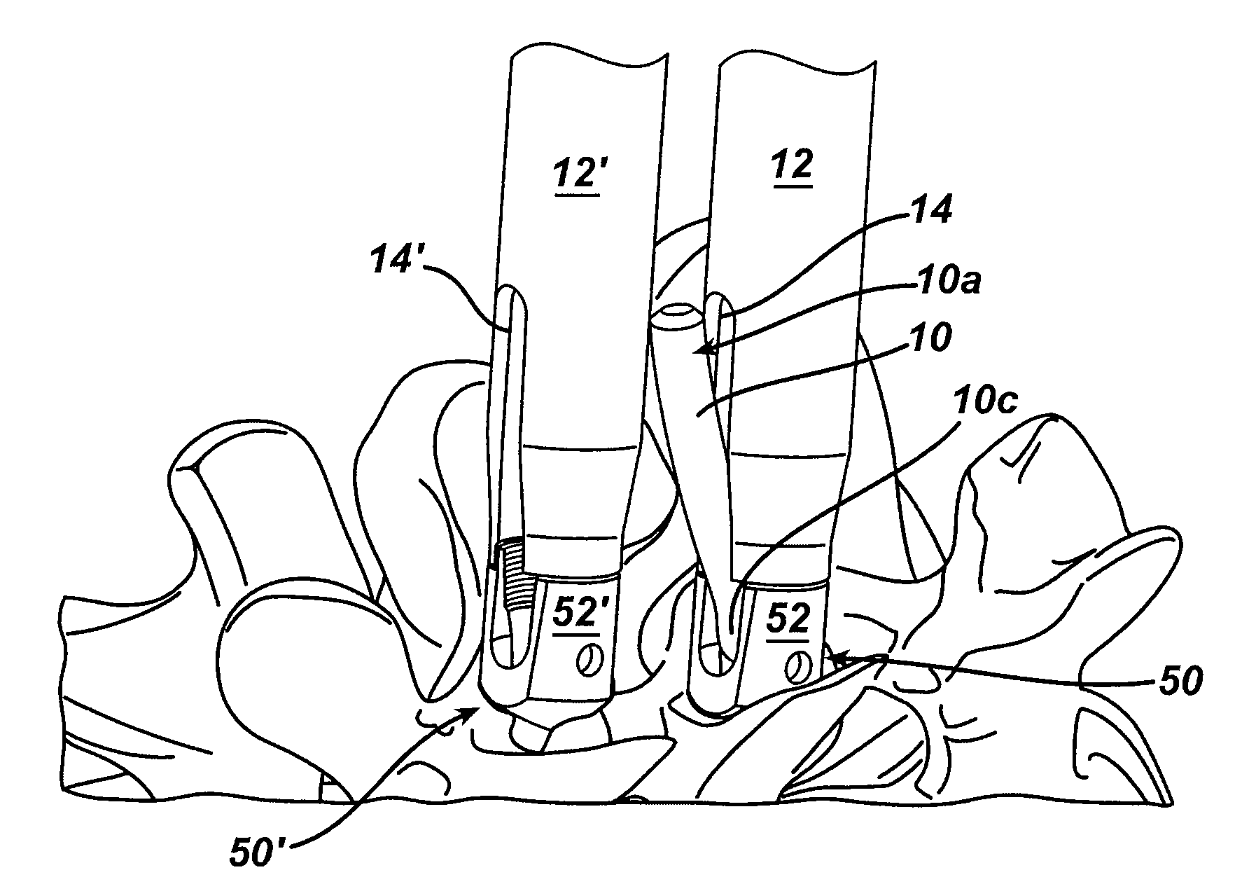 Spinal fixation element and methods