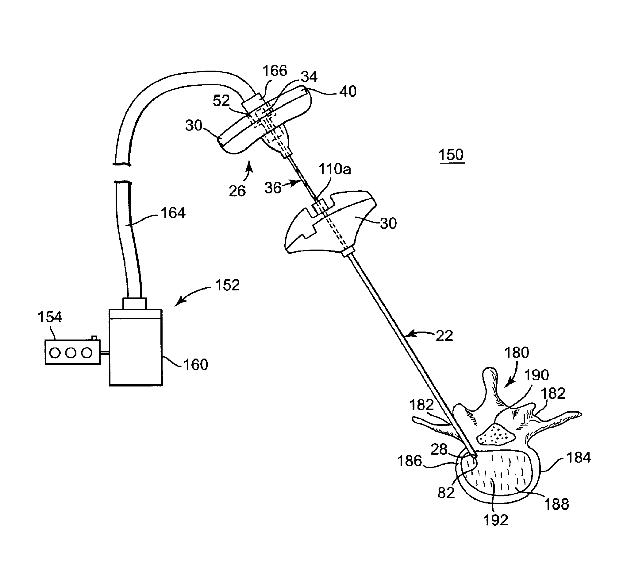 Multistate-curvature device and method for delivering a curable material into bone