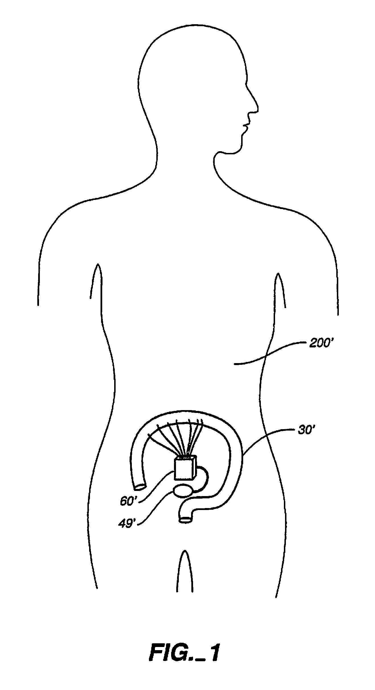 Implantable digestive tract organ